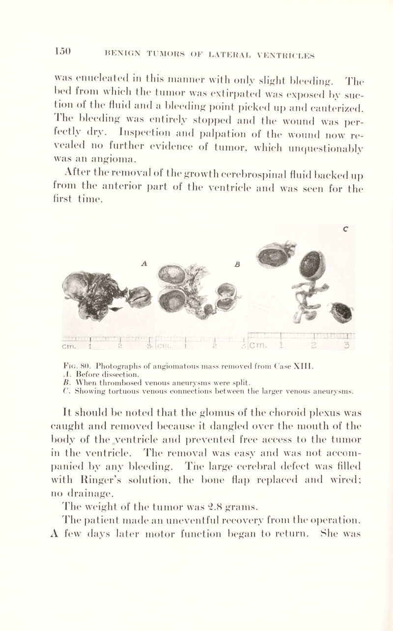 was ('nucleated in this manner with only slight bleeding. The bed from which the tumor was extirpated was exposed by suc¬ tion ol the fluid and a bleeding point picked up and cauterized. 1 he bleeding was entirely stopped and the wound was per- b < tl\ <h\. Inspection and palpation oi the wound now re¬ vealed no further evidence of tumor, which unquestionably was an angioma. Alter the removal of the growth cerebrospinal fluid backed up bom the anterior part of the ventricle and was seen for the first time. c Fig. 80. Photographs of angiomatous mass removed from Case XIII. .1. Before dissection. B. When thrombosed venous aneurysms were split. ('. Showing tortuous venous connections between the larger venous aneurysms. It should be noted that the glomus of the choroid plexus was caught and removed because it dangled over the mouth of the body of the ventricle and prevented free access to the tumor in the ventricle. The removal was easy and was not accom¬ panied by any bleeding. The large cerebral defect was filled with Ringer’s solution, the bone Hap replaced and wired; no drainage. The weight of the tumor was ^.S grams. The patient made an uneventful recovery from the operation. A few days later motor function began to return. She was