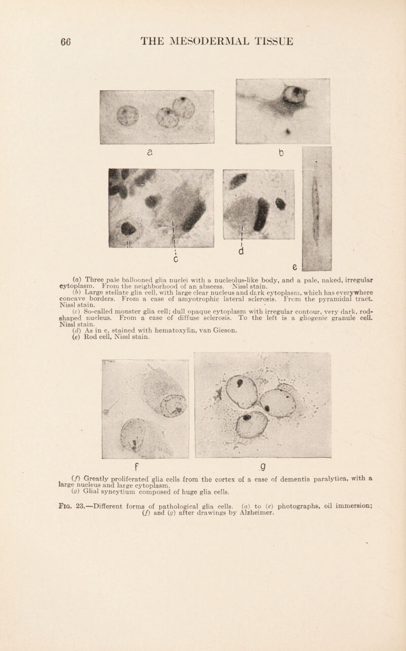 (а) Three pale ballooned glia nuclei with a nucleolus-like body, and a pale, naked, irregular cytoplasm. From the neighborhood of an abscess. ■ Nissl stain. (б) Large stellate glia cell, with large clear nucleus and dark cytoplasm, which has everywhere concave borders. From a case of amyotrophic lateral sclerosis. From the pyramidal tract. Nissl stain. (c) So-called monster glia cell; dull opaque cytoplasm with irregular contour, very dark, rod¬ shaped nucleus. From a case of diffuse sclerosis. To the left is a gliogenic granule cell. Nissl stain. (d) As in c, stained with hematoxylin, van Gieson. (e) Rod cell, Nissl stain. f 9 (/) Greatly proliferated glia cells from the cortex of a case of dementia paralytica, with a large nucleus and large cytoplasm. (ff) Glial syncytium composed of huge glia cells. Fig. 23.—Different forms of pathological glia cells, (a) to (e) photographs, oil immersion; (/) and (g) after drawings by Alzheimer.