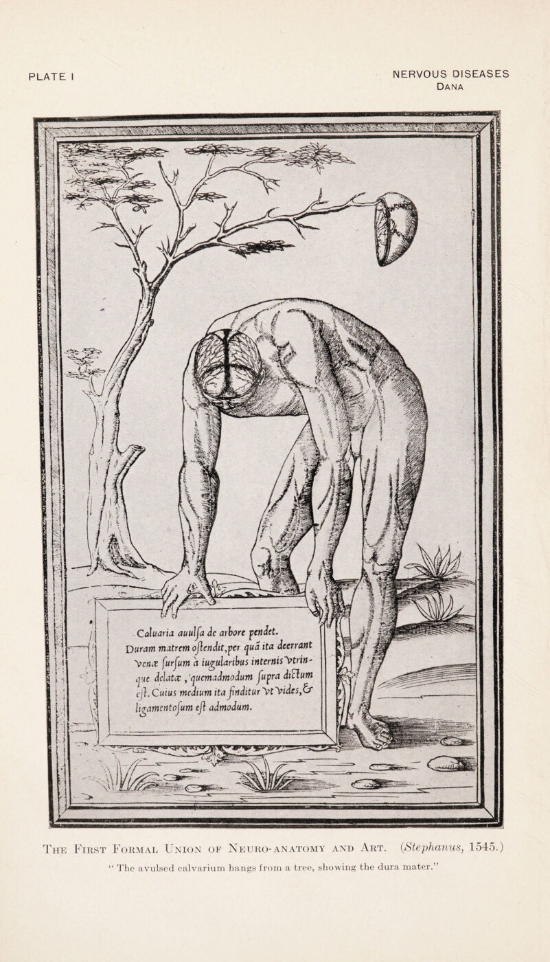•y :r.C im NERVOUS DISEASES Dana Caluaria auulja dc arbore penJct. uram matron oftendtt^et qua ita dccrrant *\>cm furjum a iugularibus intemis^triti' quc dclatcc ,'quemadmodum fupra dictum cj}. Cuius medium ita ftnditurytyidcs,& hgamentofum eft admodum. -«ey«3iw», The First Formal Union of Neuro- anatomy and Art. (Stephanus, 1545.) “ The avulsed calvarium hangs from a tree, showing the dura mater.”