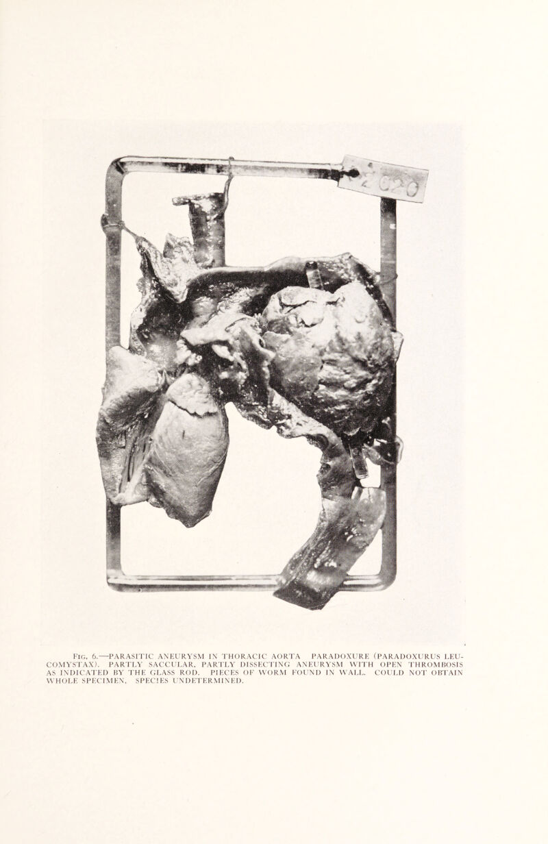 Fig, 6.—PARASITIC ANEURYSM IN THORACIC AORTA PARADOXURE (PARADOXURUS LEU- COMYSTAX). PARTLY SACCULAR, PARTLY DISSECTING ANEURYSM WITH OPEN THROMBOSIS AS INDICATED BY THE GLASS ROD. PIECES OF WORM FOUND IN WALL. COULD NOT OBTAIN WHOLE SPECIMEN, SPECIES UNDETERMINED.