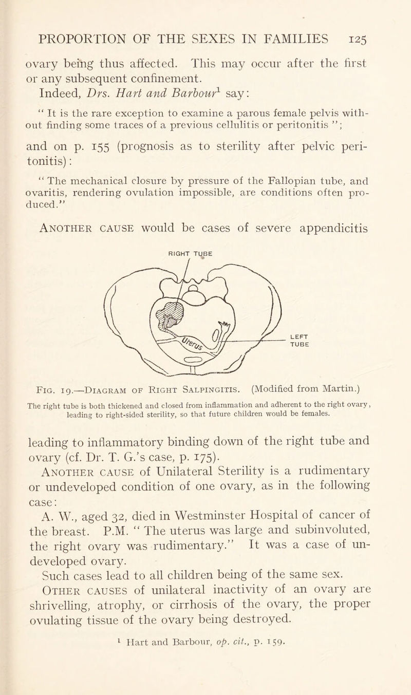 ovary being thus affected. This may occur after the first or any subsequent confinement. Indeed, Drs. Hart and Barbour1 say: “ It is the rare exception to examine a parous female pelvis with- out finding some traces of a previous cellulitis or peritonitis and on p. 155 (prognosis as to sterility after pelvic peri- tonitis) : “ The mechanical closure by pressure of the Fallopian tube, and ovaritis, rendering ovulation impossible, are conditions often pro- duced.” Another cause would be cases of severe appendicitis RIGHT TUBE Fig. 19.—Diagram of Right Salpingitis. (Modified from Martin.) The right tube is both thickened and closed from inflammation and adherent to the right ovary, leading to right-sided sterility, so that future children would be females. leading to inflammatory binding down of the right tube and ovary (cf. Dr. T. G.’s case, p. 175)• Another cause of Unilateral Sterility is a rudimentary or undeveloped condition of one ovary, as in the following case: A. W., aged 32, died in Westminster Hospital of cancer of the breast. P.M. “ The uterus was large and subinvoluted, the right ovary was rudimentary.” It was a case of un- developed ovary. Such cases lead to all children being of the same sex. Other causes of unilateral inactivity of an ovary are shrivelling, atrophy, or cirrhosis of the ovary, the proper ovulating tissue of the ovary being destroyed. 1 Hart and Barbour, op. cit., p. 159.