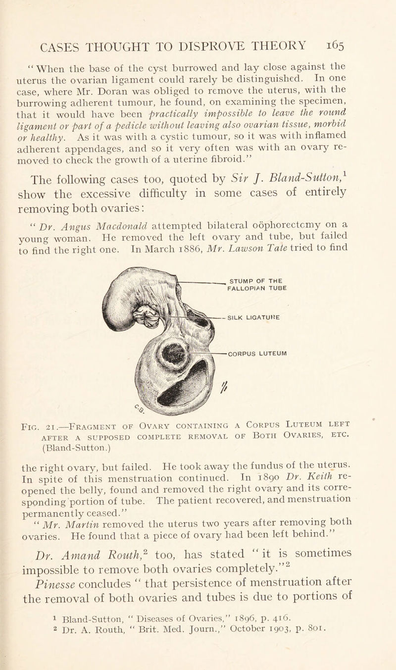 “ When the base of the cyst burrowed and lay close against the uterus the ovarian ligament could rarely be distinguished. In one case, where Mr. Doran was obliged to remove the uterus, with the burrowing adherent tumour, he found, on examining the specimen, that it would have been practically impossible to leave the round ligament or part of a pedicle without leaving also ovarian tissue, morbid or healthy. As it was with a cystic tumour, so it was with inflamed adherent appendages, and so it very often was with an ovary re- moved to check the growth of a uterine fibroid.” The following cases too, quoted by Sir J. Bland-Sutton,1 show the excessive difficulty in some cases of entirely removing both ovaries: “ Dr. Angus Macdonald attempted bilateral oophorectomy on a young woman. He removed the left ovary and tube, but failed to find the right one. In March 1886, Mr. Lawson Tate tried to find STUMP OF THE FALLOPIAN TUBE SILK LIGATURE CORPUS LUTEUM Fig. 21.—Fragment of Ovary containing a Corpus Luteum left AFTER A SUPPOSED COMPLETE REMOVAL OF BOTH OVARIES, ETC. (Bland-Sutton.) the right ovary, but failed. He took away the fundus of the uterus. In spite of this menstruation continued. In 1890 Dr. Keith re- opened the belly, found and removed the right ovary and its corre- sponding portion of tube. The patient recovered, and menstruation permanently ceased.” “ Mr. Martin removed the uterus two years after removing both ovaries. He found that a piece of ovary had been left behind.” Dr. Amand Routh,2 too, has stated it is sometimes impossible to remove both ovaries completely.” Rinesse concludes “ that persistence of menstruation after the removal of both ovaries and tubes is due to portions of 1 Bland-Sutton, “ Diseases of Ovaries,” 1896, p. 416. 2 Dr. A. Routh, “ Brit. Med. Journ.,” October 1903, p. 801.