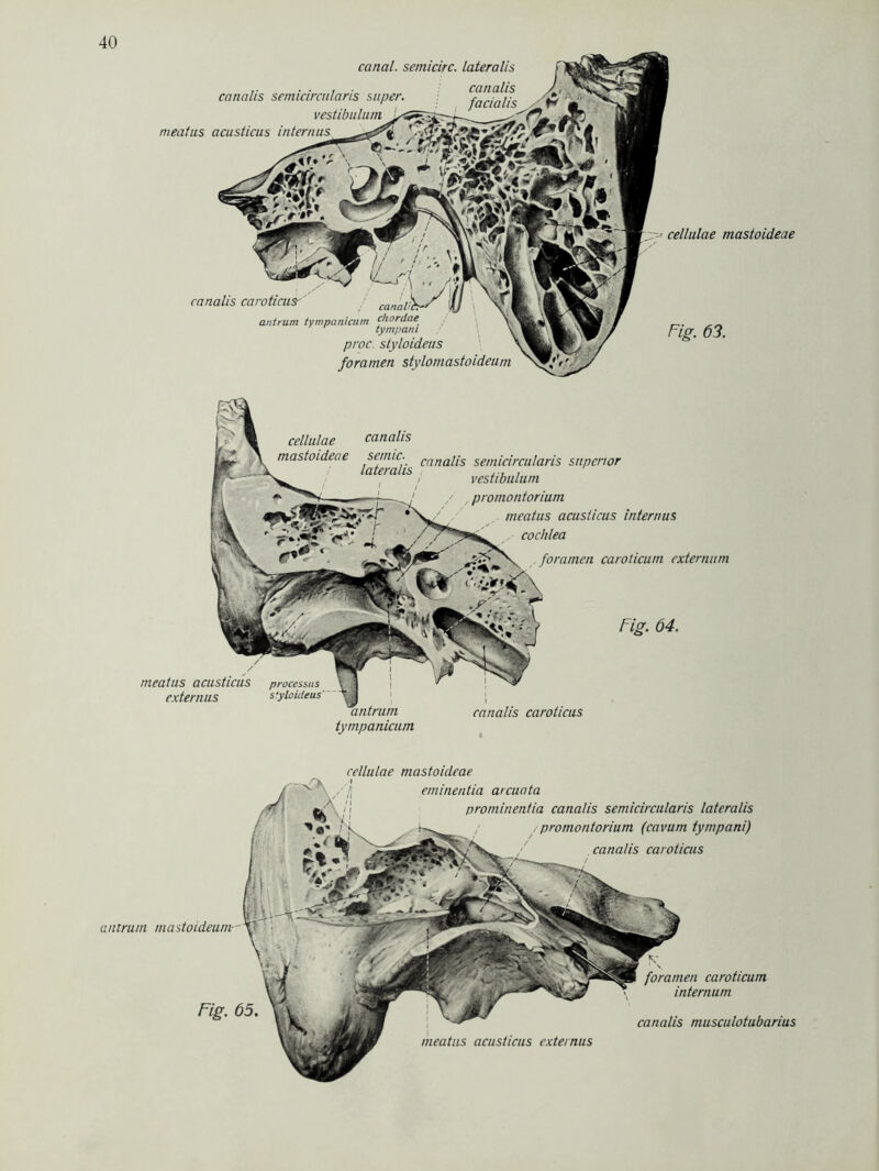 cancilis semicircnlaris super, vestibulum meatus acusticus internus canal. semicirc. Lateralis canalis --- cellulae mastoideae canalis caroticus- antrum tympanicurn chordae tympam proc. styloideus foramen stylomastoideum Fig. 63. cellulae canalis mastoideae senuc cana[is senucircularis snpertor lateralis , vestibulum promontorium meatus acusticus internus cochlea foramen caroticum externum Fig. 64. meatus acusticus processus externus sfyloideus' tympanicurn canalis caroticus cellulae mastoideae 1 eminentia arcuata l\ prominentia canalis semicircularis lateralis y promontorium (cavum tympani) canalis caroticus antrum mastoideum— Fig. 65. meatus acusticus externus fr- foramen caroticum internum canalis musculotubarius