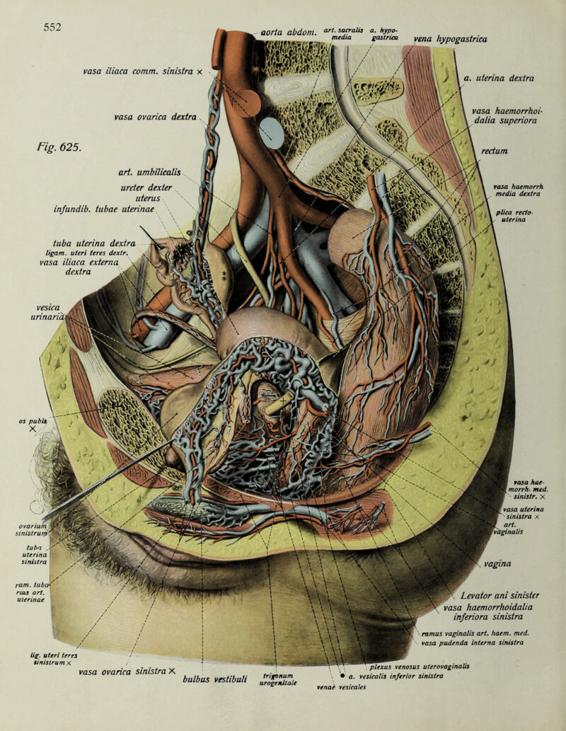 ovarium sinistrurry' aorta abdom. arU sa,cralt3 a- hyp°- meäm gastruu vena hypogastrica vasa iliaca comm. sinistra x vasa ovarica dextra Fig. 625 art. umbilicalis ureter dexter uterus infundib. tubae uterinae tuba uterina dextra ligam. uteri teres dextr. vasa iliaca externa dextra vesica urinarid \U\\V J \ a. uterina dextra / 8l|i ‘ \ vasa haemorrhoi X A VVyr \vA\ \ dalia superiora rectum rasa haemorrh media dextra / 'V< / \ plica recto uterina os pubh x rasa hae morrh. med sinistr. X ■ vasa uterina f sinistra x * art. vaginalis - tuba •- uterina sinistra vagina ram. tubcF ruis art. uterinae \ Levator ani sinister vasa haemorrhoidalia inferiora sinistra ramus vaginalis art. haem. med. vasa pudenda interna sinistra lig. uteri teres tinistrumx vasa ovarica sinistra X bulbus vestibuli IXiZie plexus venosus uterovaginalis \ * a. vesicalis inferior sinistra venae vesieales