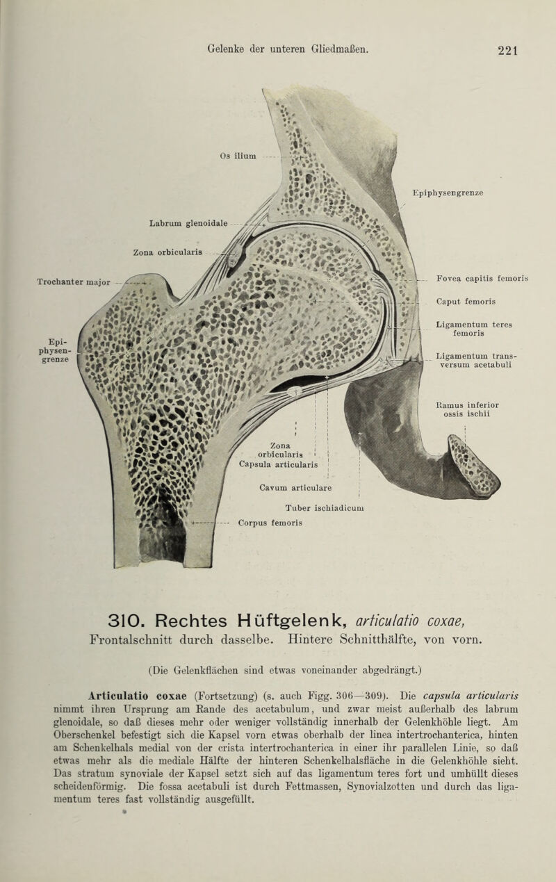 V&'iK'V}» l*i’yW \1Mll r Zona orbicularis 1 Capsula articularis Cavum articulare Os ilium Labrum glenoidale »*• ' ••#»\ • • tf *äk ft* !#*•>«' Trochanter rnajor Epiphysengrenze Fovea capitis femoris Caput femoris Ligamentum teres femoris Ligamentum trans- versum acetabuli Zona orbicularis Epi- physen- grenze Tuber ischiadicum Corpus femoris Itamus inferior ossis ischii 310. Rechtes Hüftgelenk, articulatio coxae, Frontalschnitt durch dasselbe. Hintere Schnitthälfte, von vorn. (Die Gelenkfliicken sind etwas voneinander abgedrängt.) Articulatio coxae (Fortsetzung) (s. auch Figg. 306—309). Die capsula articularis nimmt ihren Ursprung am Rande des acetabulum, und zwar meist außerhalb des labrum glenoidale, so daß dieses mehr oder weniger vollständig innerhalb der Gelenkhöhle liegt. Am Oberschenkel befestigt sich die Kapsel vorn etwas oberhalb der linea intertrochanterica, hinten am Schenkelhals medial von der crista intertrochanterica in einer ihr parallelen Linie, so daß etwas mehr als die mediale Hälfte der hinteren Schenkelhalsfläche in die Gelenkhöhle sieht. Das stratum synoviale der Kapsel setzt sich auf das ligamentum teres fort und umhüllt dieses scheidenförmig. Die fossa acetabuli ist durch Fettmassen, Synovialzotten und durch das liga- mentum teres fast vollständig ausgefüllt.