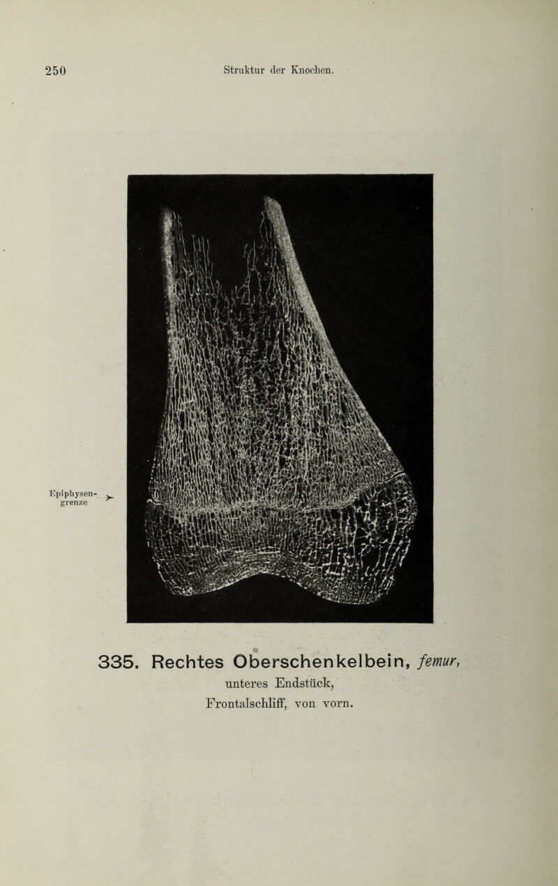 Epiphysen- . grenze 335. Rechtes Oberschenkelbein, femur, unteres Endstück,