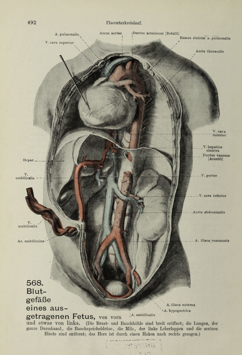 Aa. umbilicales A. iliaca'communis 568. Blut- gefäße eines aus- getragenen Fetus, von vorn und etwas von links. (Die Brust- uncl Bauchhöhle sind breit eröffnet; die Lungen, der ganze Darmkanal, die Bauchspeicheldrüse, die Milz, der linke Leherlappen und die serösen Häute sind entfernt; das Herz ist durch einen Haken nach rechts gezogen.) ! A. umbilicalis A. iliaca externa A. hypogastrica A. pulmonalis. \ V. cava superior Arcus aortae I l V. cava inferior —V. cava inferior -Aorta abdominalis V. / umbilicalis Hepar umbilicalis —V. portae ■ Ductus arteriosus [Botalli] Kamus sinister a. pulmonalis Aorta thoracalis V. hepatica sinistra Ductus venosus fArantii]