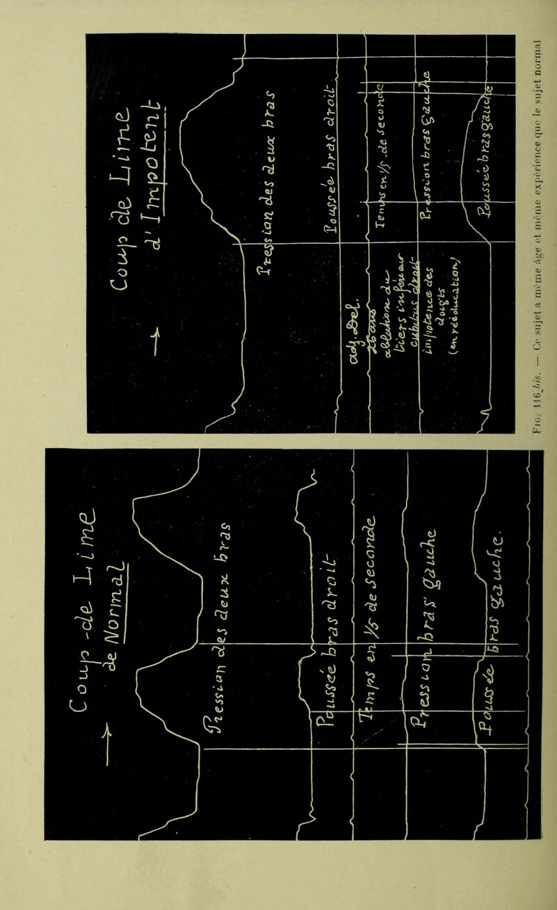 ^ Noniza.1 Fig. 116j>is. — Ce sujet a même âge et même expérience que le sujet normal