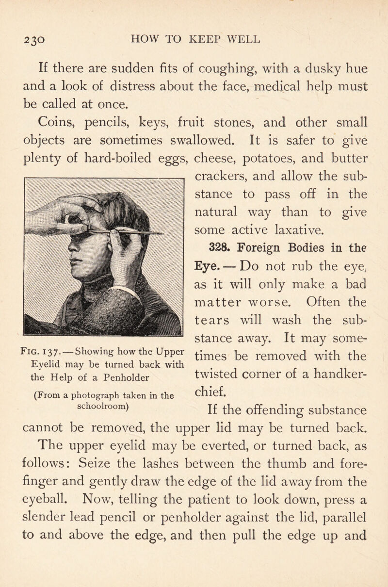 If there are sudden fits of coughing, with a dusky hue and a look of distress about the face, medical help must be called at once. Coins, pencils, keys, fruit stones, and other small objects are sometimes swallowed. It is safer to give plenty of hard-boiled eggs, cheese, potatoes, and butter crackers, and allow the sub- stance to pass off in the natural way than to give some active laxative. 328. Foreign Bodies in the Eye. — Do not rub the eye, as it will only make a bad matter worse. Often the tears will wash the sub- stance away. It may some- Fig. 137-Showing how the Upper t;mes bg removed with the Eyelid may be turned back with the Help Of a Penholder twisted corner of a handker- (From a photograph taken in the chief. schoolroom) If offending substance cannot be removed, the upper lid may be turned back. The upper eyelid may be everted, or turned back, as follows: Seize the lashes between the thumb and fore- finger and gently draw the edge of the lid away from the eyeball. Now, telling the patient to look down, press a slender lead pencil or penholder against the lid, parallel to and above the edge, and then pull the edge up and