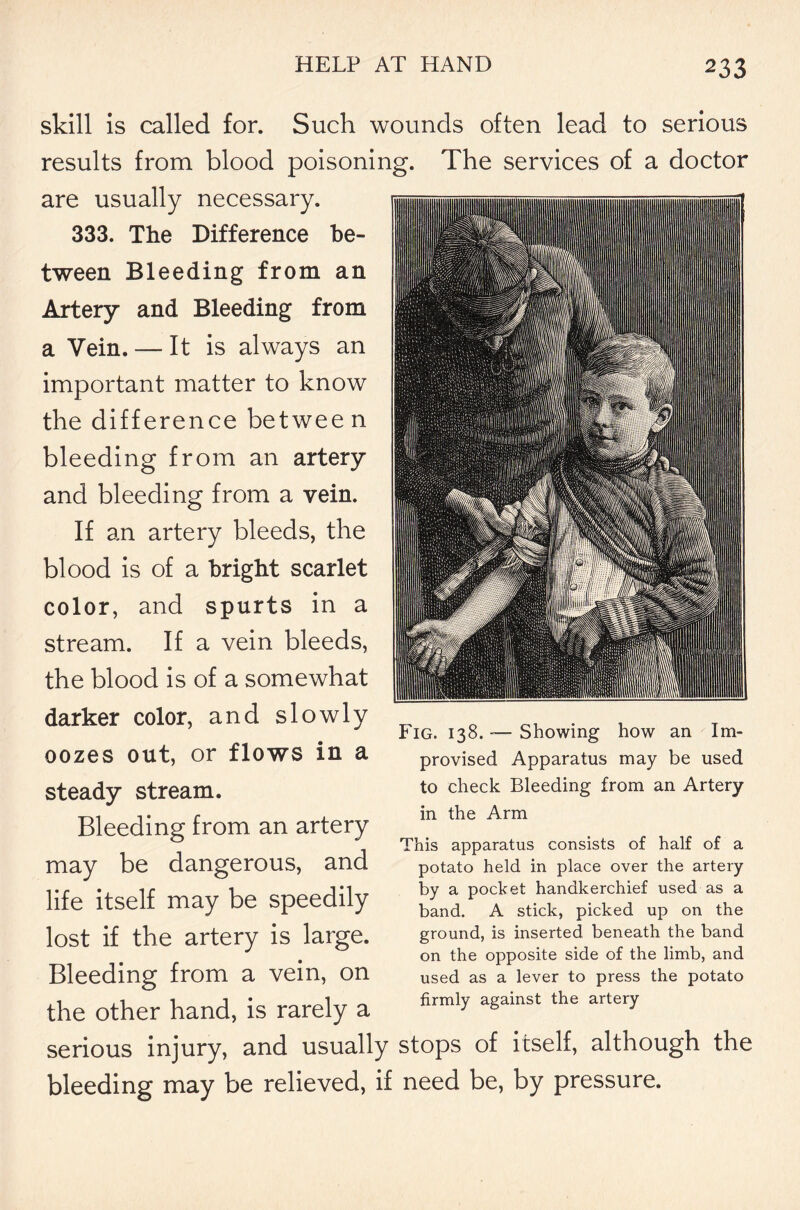 skill is called for. Such wounds often lead to serious results from blood poisoning. The services of a doctor are usually necessary. 333. The Difference be- tween Bleeding from an Artery and Bleeding from a Vein. — It is always an important matter to know the difference between bleeding from an artery and bleeding from a vein. If an artery bleeds, the blood is of a bright scarlet color, and spurts in a stream. If a vein bleeds, the blood is of a somewhat darker color, and slowly oozes out, or flows in a steady stream. Bleeding from an artery may be dangerous, and life itself may be speedily lost if the artery is large. Bleeding from a vein, on the other hand, is rarely a serious injury, and usually stops of itself, although the bleeding may be relieved, if need be, by pressure. Fig. 138. — Showing how an Im- provised Apparatus may be used to check Bleeding from an Artery in the Arm This apparatus consists of half of a potato held in place over the artery by a pocket handkerchief used as a band. A stick, picked up on the ground, is inserted beneath the band on the opposite side of the limb, and used as a lever to press the potato firmly against the artery