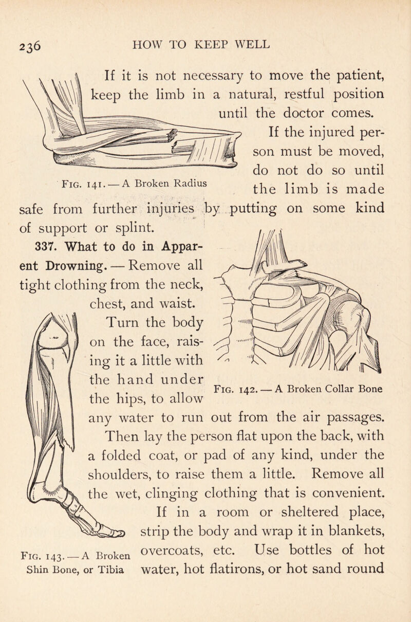 If it is not necessary to move the patient, keep the limb in a natural, restful position until the doctor comes. If the injured per- son must be moved, do not do so until Fig. .41.-A Broken Radius the limb is made • (• •••*’ ■' \. .i safe from further injuries by putting on some kind > i' of support or splint. 337. What to do in Appar- ent Drowning. — Remove all tight clothing from the neck, chest, and waist. Turn the body on the face, rais- ing it a little with the hand under the hips, to allow any water to run out from the air passages. Then lay the person flat upon the back, with a folded coat, or pad of any kind, under the shoulders, to raise them a little. Remove all the wet, clinging clothing that is convenient. If in a room or sheltered place, strip the body and wrap it in blankets, Fig. 143.-A Broken overcoats, etc. Use bottles of hot Shin Bone, or Tibia water, hot flatirons, or hot sand round Fig. 142. — A Broken Collar Bone