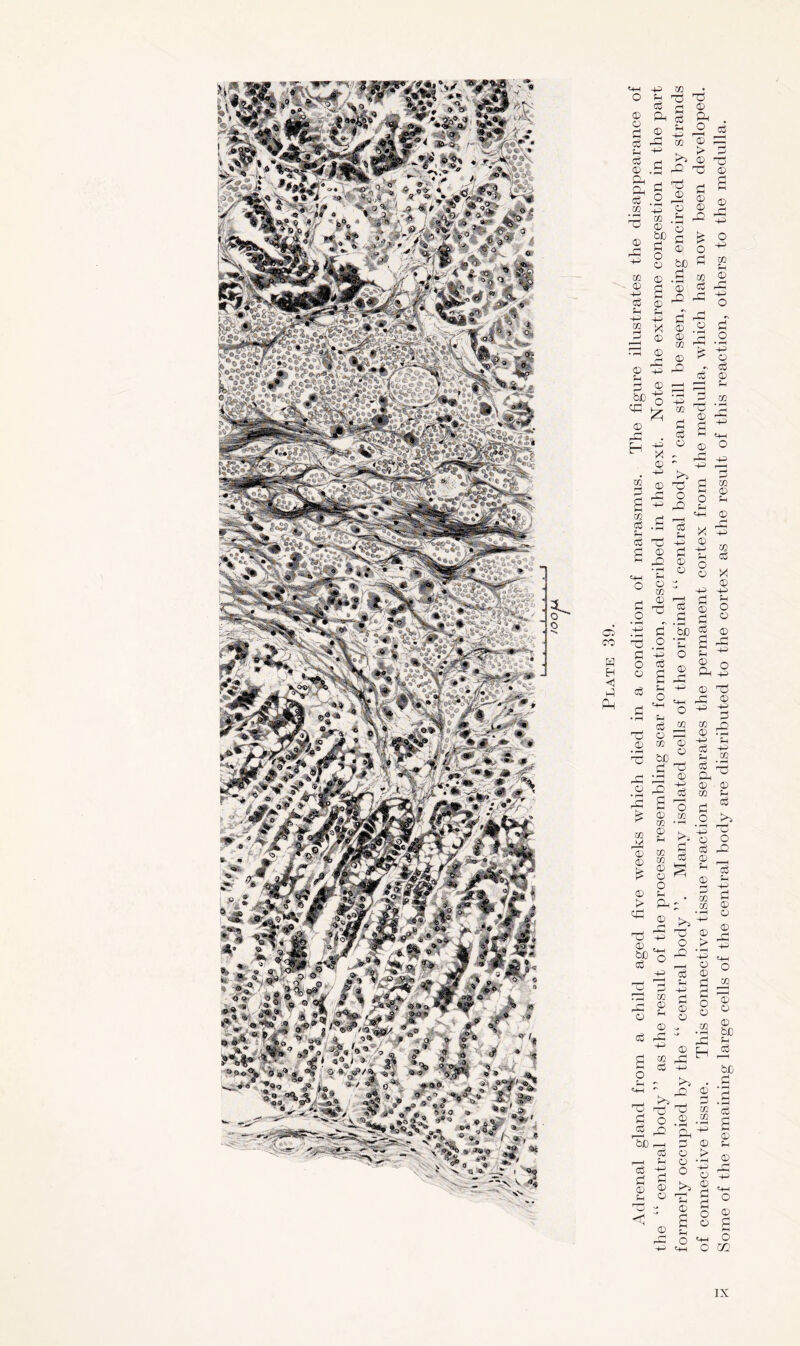 3- o “ W s i ^ * s, Q *s -.,.£ I «© » ■* , J _ - x ^ OS co W EH ◄ (-1 PM Adrenal gland from a child aged five weeks which died in a condition of marasmus. The figure illustrates the disappearance of the “ central body ” as the result of the process resembling scar formation, described in the text. Note the extreme congestion in the part formerly occupied by the “ central body ”. Many isolated cells of the original “ central body ” can still be seen, being encircled by strands of connective tissue. This connective tissue reaction separates the permanent cortex from the medulla, which has now been developed. Some of the remaining large cells of the central body are distributed to the cortex as the result of this reaction, others to the medulla.