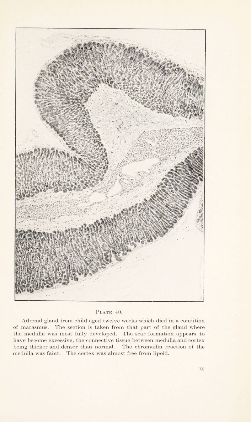 Adrenal gland from child aged twelve weeks which died in a condition of marasmus. The section is taken from that part of the gland where the medulla was most fully developed. The scar formation appears to have become excessive, the connective tissue between medulla and cortex being thicker and denser than normal. The chromaffin reaction of the medulla was faint. The cortex was almost free from lipoid.