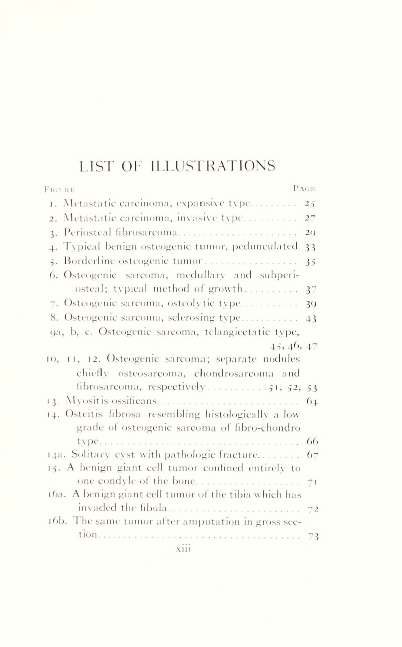 LIST OF ILLUSTRATIONS Fll.l HI I’ai.I 1. Metastatic carcinoma, expansive type... 23 2. Metastatic carcinoma, invasive type . 2“ 3. Periosteal fibrosarcoma. 20 4. Typical benign osteogenic tumor, pedunculated 33 3. Borderline osteogenic tumor. 35 6. Osteogenic sarcoma, medullary and subperi¬ osteal; typical method of growth. 37 Osteogenic sarcoma, osteolytic type. 39 5. Osteogenic sarcoma, sclerosing type. 43 pa, b, c. Osteogenic sarcoma, telangiectatic type, 4s, 4b, 47 10, 11, 12. Osteogenic sarcoma; separate nodules chiefly osteosarcoma, chondrosarcoma and fibrosarcoma, respectively.51, 32, 53 1 3. Myositis ossificans. 64 14. Osteitis fibrosa resembling histologically a low grade of osteogenic sarcoma of (ibro-chondro type.66 14a. Solitary cyst with pathologic fracture.67 13. A benign giant cell tumor confined entirely to one condy le of the bone. 71 16a. A benign giant cell tumor of the tibia which has invaded the fibula. 72 16b. The same tumor after amputation in gross sec¬ tion. -3