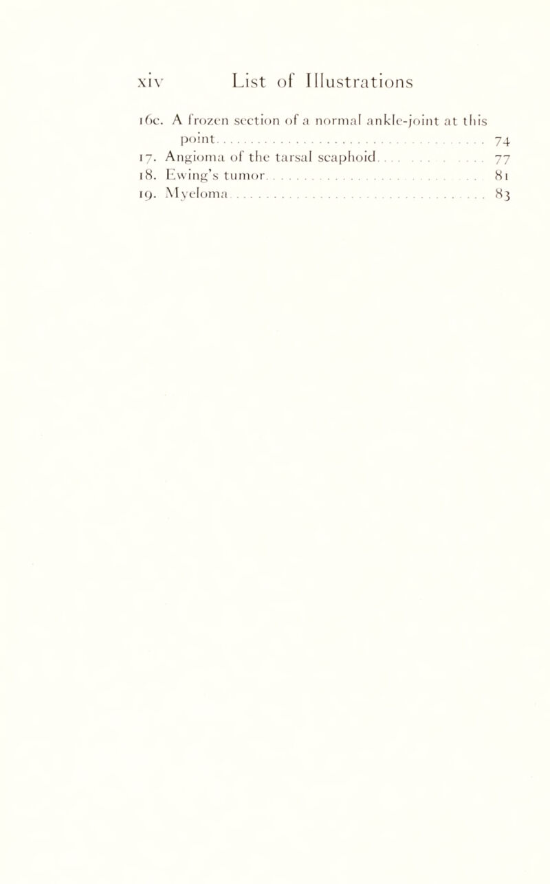 16c. A frozen section of a normal ankle-joint at this point. 74 17. Angioma of the tarsal scaphoid 77 18. Ewing’s tumor. 81 19. Myeloma. 83
