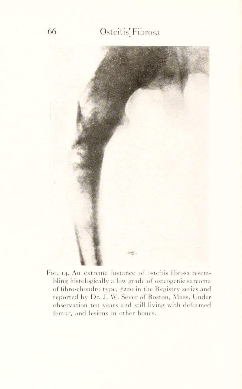 Fig. 14. An extreme instance of osteitis fibrosa resem¬ bling histologically a low grade of osteogenic sarcoma of iibro-chondro type, -If 22o in the Registry series and reported by Dr. J. \V. Sever of Boston, Mass. Under observation ten years and still living with deformed femur, and lesions in other bones.