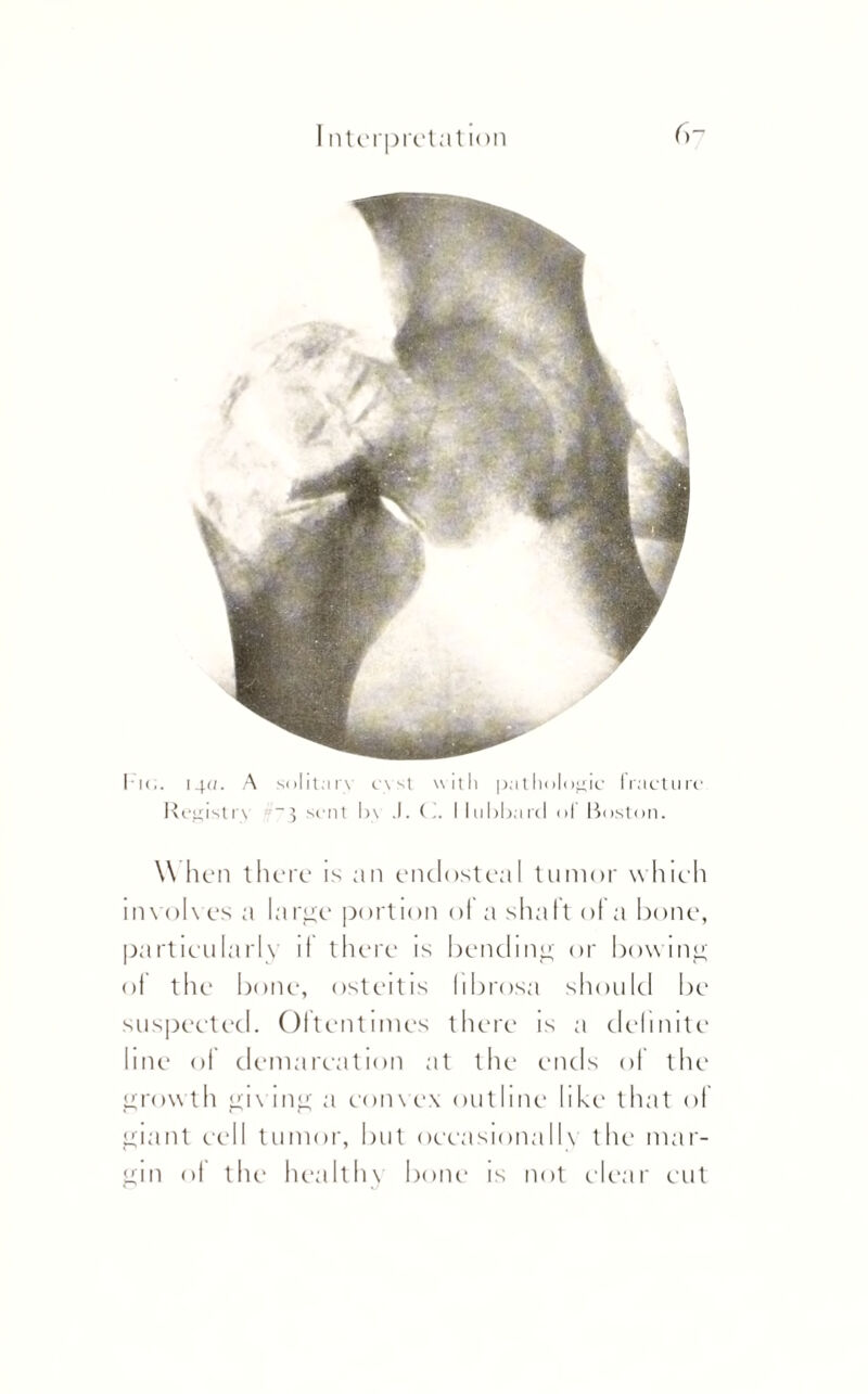 I k;. 14a. A solitary cyst with pathologic Iracturc Registry sent by .1. (.. Hubbard ol Boston. \\ hen there is an endosteal tumor w hich involves a large portion ol a shalt of a bone, particularly it there is bending or bowing ol the bone, osteitis (ibrosa should be suspected. Oftentimes there is a definite line of demarcation at the ends of the growth giving a convex outline like- that of giant cell tumor, but occasionally the mar¬ gin of the healthy bone is not clear cut