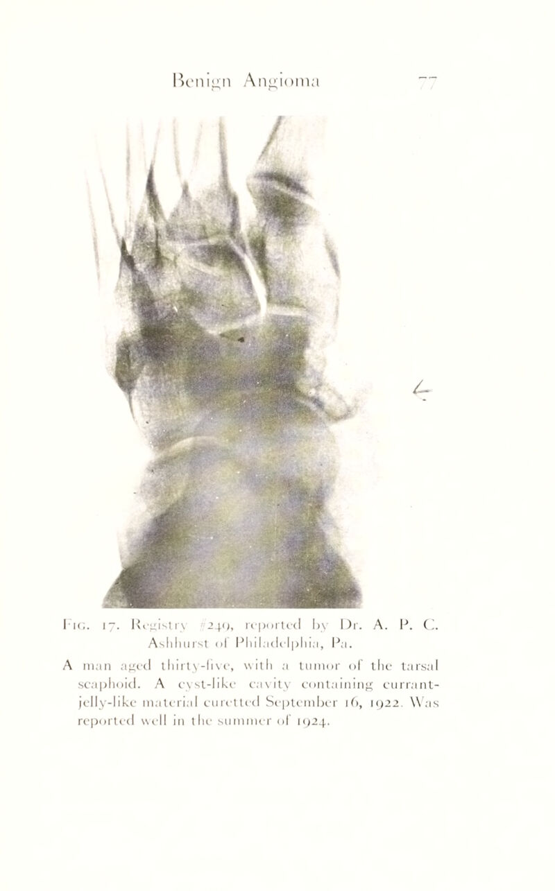 Benign Angioma / / / ho. i~. Registry 240, reported by Dr. A. P. C. Ashhurst ol Philadelphia, Pa. A man aged thirty-live, with a tumor ol' the tarsal scaphoid. A cyst-like cavity containing currant- jelly-like material curetted September 16, 1922. Was reported well in the- summer of 1924.