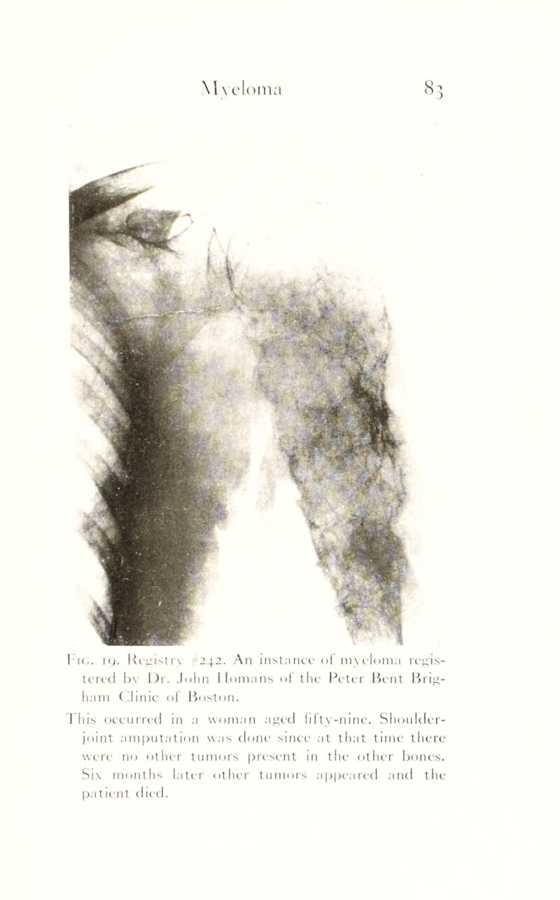 \ I veloma I k,. K). Registry *242. An instance ol myeloma regis¬ tered by Dr. John llontans of the Peter Bent Brig¬ ham Clinic of Boston. This occurred in a woman aged fifty-nine. Shoulder- joint amputation was done since at that time there were no other tumors present in the other bones. Six months later other tumors appeared and the patient died.