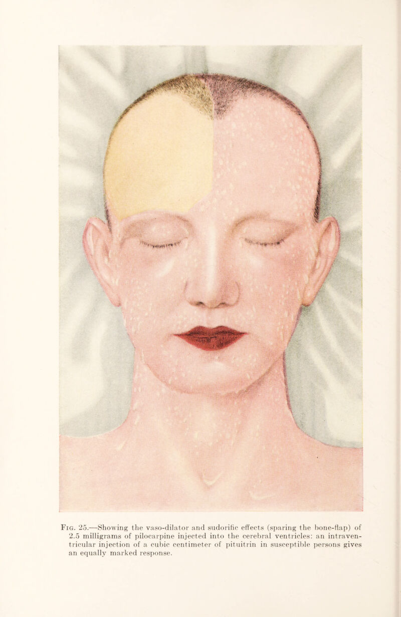 Fig. 25.—Showing the vaso-dilator and sudorific effects (sparing the bone-flap) of 2.5 milligrams of pilocarpine injected into the cerebral ventricles: an intraven¬ tricular injection of a cubic centimeter of pituitrin in susceptible persons gives an equally marked response.