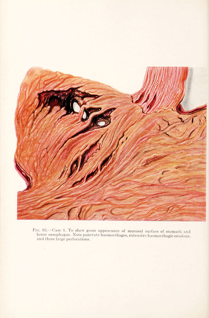 I ig. S3. Case 1. 1 o show gross appearance of mucosal surface of stomach and lower oesophagus. Note punctate haemorrhages, extensive haemorrhagic erosions, and three large perforations.
