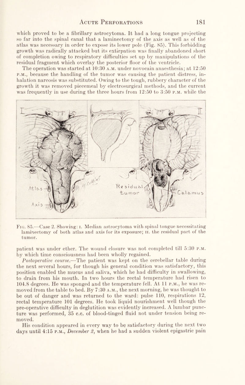 which proved to be a fibrillary astrocytoma. It had a long tongue projecting so far into the spinal canal that a laminectomy of the axis as well as of the atlas was necessary in order to expose its lower pole (Fig. 85). This forbidding growth was radically attacked but its extirpation was finally abandoned short of completion owing to respiratory difficulties set up by manipulations of the residual fragment which overlay the posterior floor of the ventricle. The operation was started at 10:30 a.m. under novocain anaesthesia; at 12:50 p.m., because the handling of the tumor was causing the patient distress, in¬ halation narcosis was substituted. Owing to the tough, rubbery character of the growth it was removed piecemeal by electrosurgical methods, and the current was frequently in use during the three hours from 12:50 to 3:50 p.m. while the Sv I m u 5 Fro. 85.—Case 2. Showing: i. Median astrocytoma with spinal tongue necessitating laminectomy of both atlas and axis for its exposure; ii. the residual part of the tumor. patient was under ether. The wound closure was not completed till 5:30 p.m. by which time consciousness had been wholly regained. Postoperative course.—The patient was kept on the cerebellar table during the next several hours, for though his general condition was satisfactory, this position enabled the mucus and saliva, which he had difficulty in swallowing, to drain from his mouth. In two hours the rectal temperature had risen to 104.8 degrees. He was sponged and the temperature fell. At 11 p.m., he was re¬ moved from the table to bed. By 7:30 a.m., the next morning, he was thought to be out of danger and was returned to the ward: pulse 110, respirations 12, rectal temperature 101 degrees. He took liquid nourishment well though the pre-operative difficulty in deglutition was evidently increased. A lumbar punc¬ ture was performed, 35 c.c. of blood-tinged fluid not under tension being re¬ moved. His condition appeared in every way to be satisfactory during the next two days until 4:15 p.m., December 2, when he had a sudden violent epigastric pain