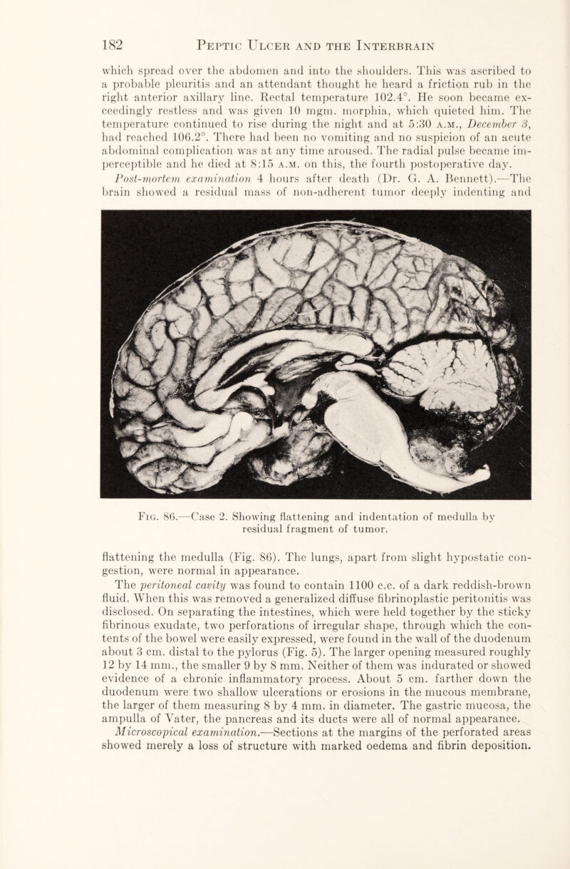 which spread over the abdomen and into the shoulders. This was ascribed to a probable pleuritis and an attendant thought he heard a friction rub in the right anterior axillary line. Rectal temperature 102.4°. He soon became ex¬ ceedingly restless and was given 10 mgm. morphia, which quieted him. The temperature continued to rise during the night and at 5:30 a.m., December 8, had reached 106.2°. There had been no vomiting and no suspicion of an acute abdominal complication was at any time aroused. The radial pulse became im¬ perceptible and he died at 8:15 a.m. on this, the fourth postoperative day. Post-mortem examination 4 hours after death (Dr. G. A. Bennett).—The brain showed a residual mass of non-adherent tumor deeply indenting and Fig. 86.—Gase 2. Showing flattening and indentation of medulla by residual fragment of tumor. flattening the medulla (Fig. 86). The lungs, apart from slight hypostatic con¬ gestion, were normal in appearance. The peritoneal cavity was found to contain 1100 c.c. of a dark reddish-brown fluid. When this was removed a generalized diffuse fibrinoplastic peritonitis was disclosed. On separating the intestines, which were held together by the sticky fibrinous exudate, two perforations of irregular shape, through which the con¬ tents of the bowel were easily expressed, were found in the wall of the duodenum about 3 cm. distal to the pylorus (Fig. 5). The larger opening measured roughly 12 by 14 mm., the smaller 9 by 8 mm. Neither of them was indurated or showed evidence of a chronic inflammatory process. About 5 cm. farther down the duodenum were two shallow ulcerations or erosions in the mucous membrane, the larger of them measuring 8 by 4 mm. in diameter. The gastric mucosa, the ampulla of Vater, the pancreas and its ducts were all of normal appearance. Microscopical examination.—Sections at the margins of the perforated areas showed merely a loss of structure with marked oedema and fibrin deposition.
