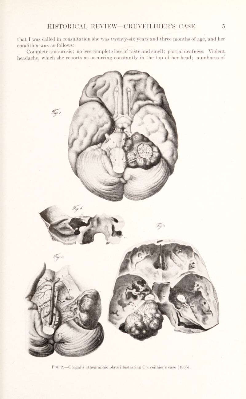 that I was called in consultation she was twenty-six years and three months of age, and her condition was as follows: Complete amaurosis; no less complete loss of taste and smell; partial deafness. Violent headache, which she reports as occurring constantly in the top of her head; numbness of Fig. 2.—Chazal’s lithographic plate illustrating Cruveilhier’s case (1835).