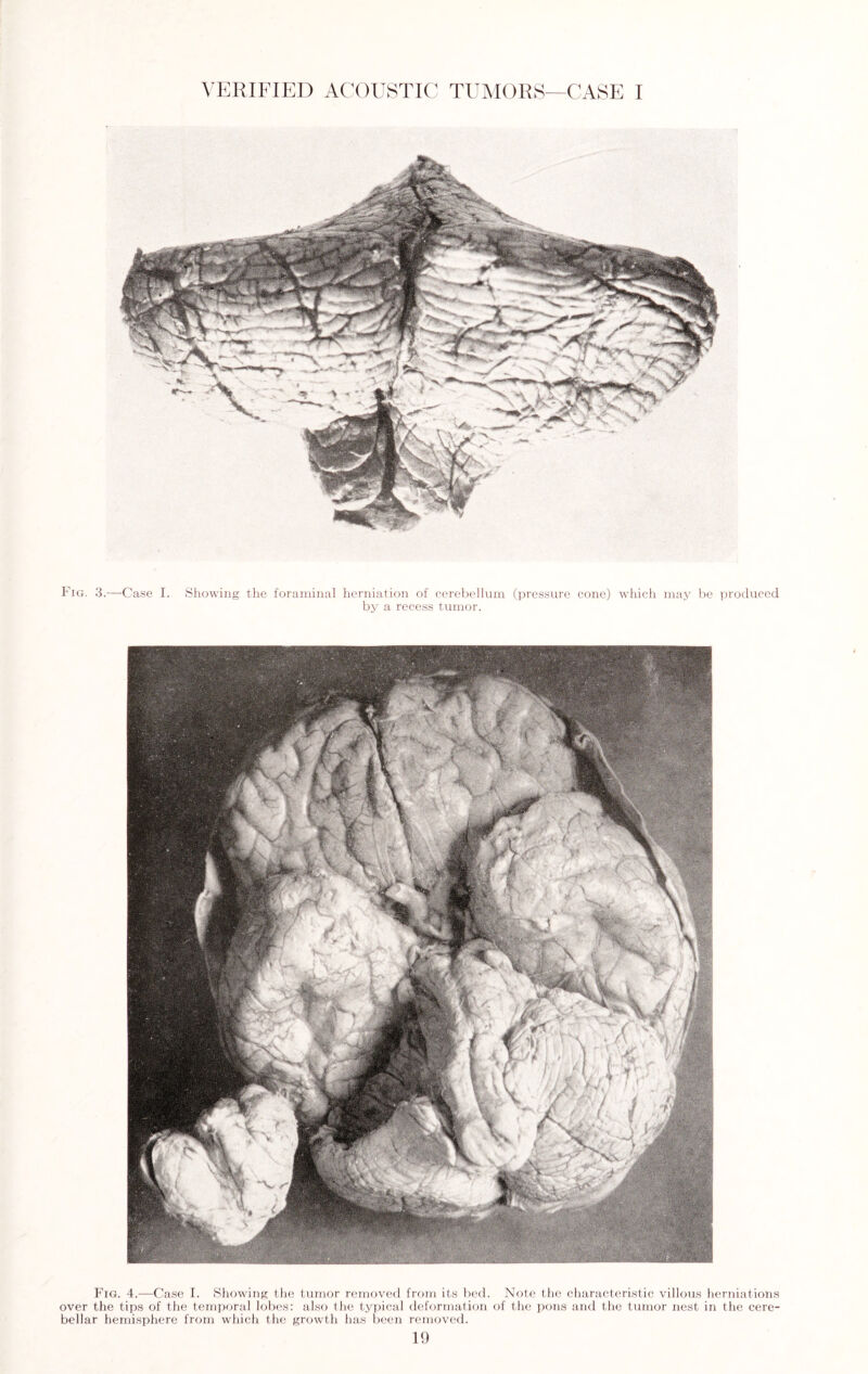 Fig. 3.—Case I. Showing the foraminal herniation of cerebellum by a recess tumor. (pressure cone) which may be produced Fig. 4.—Case I. Showing the tumor removed from its bed. Note the characteristic villous herniations over the tips of the temporal lobes: also the typical deformation of the pons and the tumor nest in the cere¬ bellar hemisphere from which the growth has been removed.