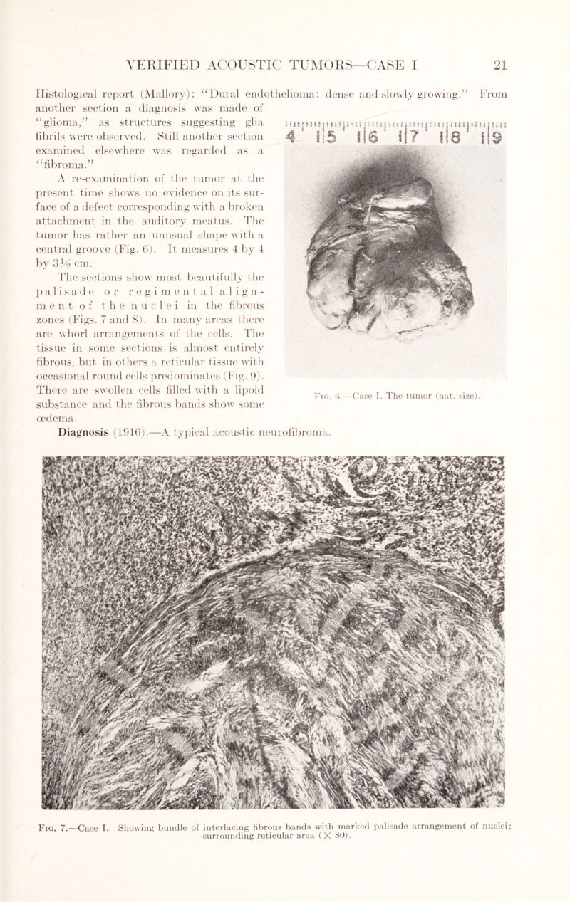 Histological report (Mallory): “Dural endothelioma: dense and slowly growing.” From another section a diagnosis was made of “glioma,” as structures suggesting glia fibrils were observed. Still another section examined elsewhere was regarded as a “fibroma.” A re-examination of the tumor at the present time shows no evidence on its sur¬ face of a defect corresponding with a broken attachment in the auditory meatus. The tumor has rather an unusual shape with a central groove (Fig. 6). It measures 4 by 4 by 319 cm. The sections show most beautifully the palisade or regimental align¬ ment of the nuclei in the fibrous zones (Figs. 7 and 8). In many areas there are whorl arrangements of the cells. The tissue in some sections is almost entirely fibrous, but in others a reticular tissue with occasional round cells predominates (Fig. 9). There are swollen cells filled with a lipoid substance and the fibrous bands show some oedema. Diagnosis (1916).—A typical acoustic neurofibroma. Fig. 7.—Case I. Showing bundle of interlacing fibrous bands with marked palisade arrangement of nuclei; surrounding reticular area (X 80).