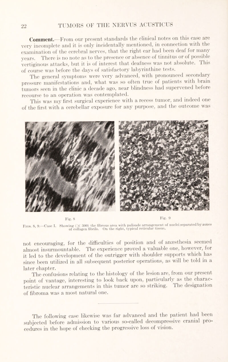 99 TUMORS OF THE NERVUS ACUSTICUS Comment.—From our present standards the clinical notes on this case are very incomplete and it is only incidentally mentioned, in connection with the examination of the cerebral nerves, that the right ear had been deaf for many years. There is no note as to the presence or absence of tinnitus or of possible vertiginous attacks, but it is of interest that deafness was not absolute. This of course was before the days of satisfactory labyrinthine tests. The general symptoms were very advanced, with pronounced secondary pressure manifestations and, what was so often true of patients with brain tumors seen in the clinic a decade ago, near blindness had supervened before recourse to an operation was contemplated. This was my first surgical experience with a recess tumor, and indeed one of the first with a cerebellar exposure for any purpose, and the outcome was Fig. 8 Fig. 9 Figs 8 9.—Case I. Showing (X 300) the fibrous area with palisade arrangement of nuclei separated by zones of collagen fibrils. On the right, typical reticular tissue. not encouraging, for the difficulties of position and of anaesthesia seemed almost insurmountable. The experience proved a valuable one, however, for it led to the development of the outrigger with shoulder supports which has since been utilized in all subsequent posterior operations, as will be told in a later chapter. The confusions relating to the histology of the lesion are, from our present point of vantage, interesting to look back upon, particularly as the charac¬ teristic nuclear arrangements in this tumor are so striking. The designation of fibroma was a most natural one. The following case likewise was far advanced and the patient had been subjected before admission to various so-called decompressive cranial pro¬ cedures in the hope of checking the progressive loss of vision.