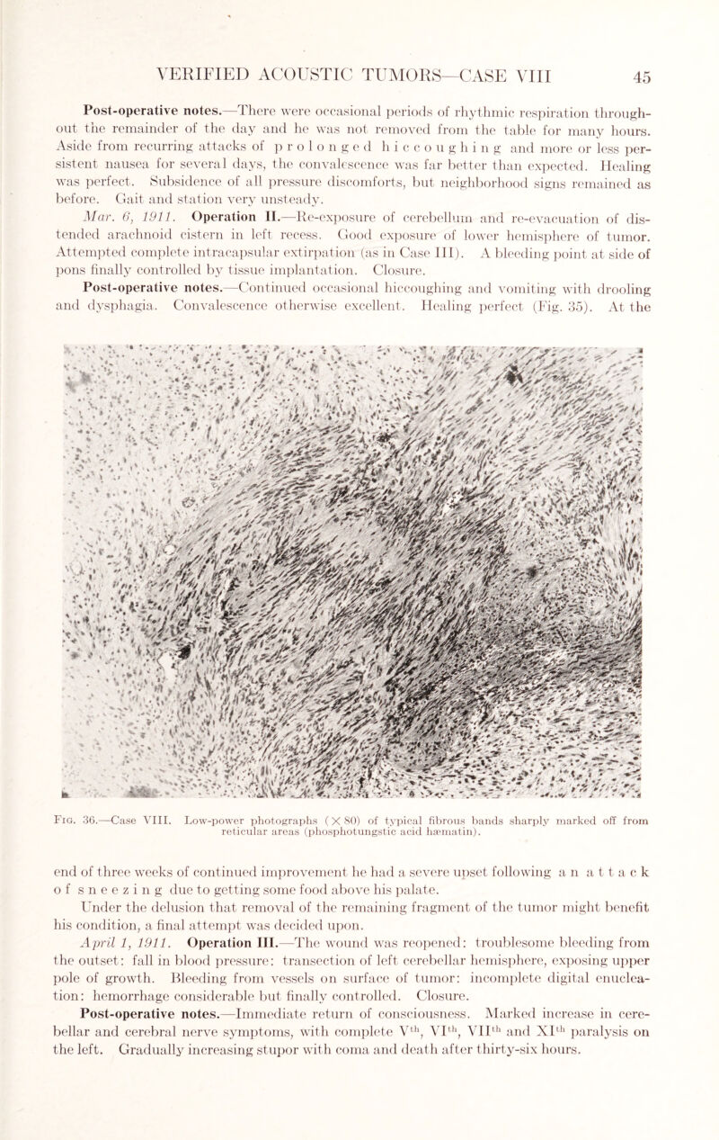 Post-operative notes. There were occasional periods of rhythmic respiration through¬ out tne remainder of the day and he was not removed from the table for many hours. Aside from recurring attacks of prolonged hiccoughing and more or less per¬ sistent nausea for several days, the convalescence was far better than expected. Healing was perfect. Subsidence of all pressure discomforts, but neighborhood signs remained as before. Gait and station very unsteady. Mar. 6, 1911. Operation II.—Re-exposure of cerebellum and re-evacuation of dis¬ tended arachnoid cistern in left recess. Good exposure of lower hemisphere of tumor. Attempted complete intracapsular extirpation (as in Case III). A bleeding point at side of pons finally controlled by tissue implantation. Closure. Post-operative notes.—Continued occasional hiccoughing and vomiting with drooling and dysphagia. Convalescence otherwise excellent. Healing perfect (Fig. 35). At the A * 'A- - ST * A# s •*? ** . »*. 4 *. v i ^ &4 * $ * .# * e < “ V | 4t * * v V - f % * 1 x. « 9 m, ’ A f * Fig. 36.—Case VIII. Low-power photographs (X 80) of typical fibrous bands sharply marked off from reticular areas (phosphotungstic acid haematin). end of three weeks of continued improvement he had a severe upset following an attack of sneezing due to getting some food above his palate. Under the delusion that removal of the remaining fragment of the tumor might benefit his condition, a final attempt was decided upon. April 1, 1911. Operation III.—The wound was reopened: troublesome bleeding from the outset: fall in blood pressure: transection of left cerebellar hemisphere, exposing upper pole of growth. Bleeding from vessels on surface of tumor: incomplete digital enuclea¬ tion: hemorrhage considerable but finally controlled. Closure. Post-operative notes.—Immediate return of consciousness. Marked increase in cere¬ bellar and cerebral nerve symptoms, with complete Vth, VIth, VIIth and XIth paralysis on the left. Gradually increasing stupor with coma and death after thirty-six hours.
