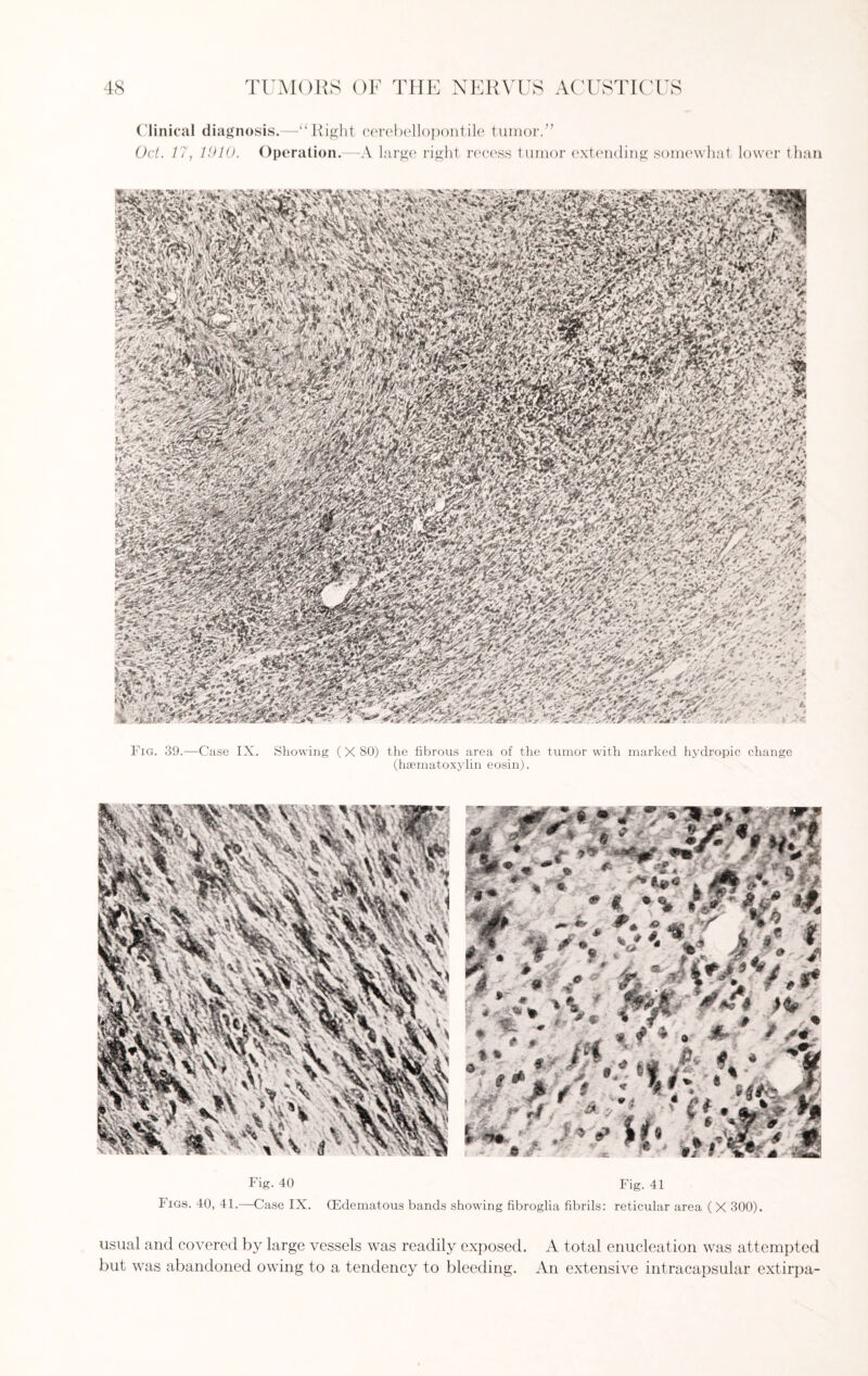 Clinical diagnosis.—“Right cerebellopontile tumor.” Oct. 17, 1910. Operation.—A large right recess tumor extending somewhat lower than aim1 * , ♦ FjC'fv m mmm WmM 'mfzM V>v^iv'r- 'rA*.' 25gg&53?' ArATc > V- mm Ww&i Fig. 39.—Case IX. Showing (X 80) the fibrous area of the tumor with marked hydropic change (hsematoxylin eosin). Fig. 40 Fig. 41 Figs. 40, 41.—Case IX. (Edematous bands showing fibroglia fibrils: reticular area ( X 300). usual and covered by large vessels was readily exposed. A total enucleation was attempted but was abandoned owing to a tendency to bleeding. An extensive intracapsular extirpa-