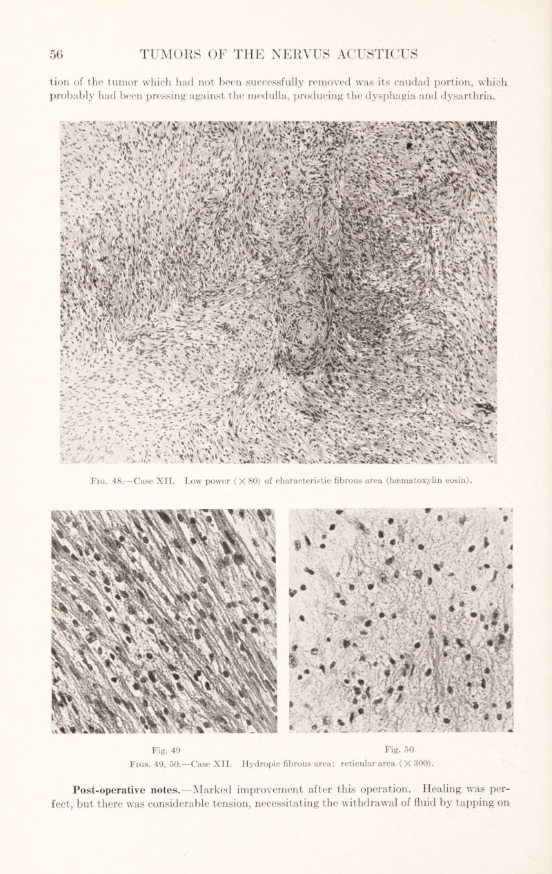 tion of the tumor which had not been successfully removed was its caudad portion, which probably had been pressing against the medulla, producing the dysphagia and dysarthria. »’ - ►_> -i s...» \* Mi Fig. 48.—Case XII. Low power (X 80) of characteristic fibrous area (hsematoxylin eosin). Fig. 49 Fig. 50 Figs. 49, 50.—Case XII. Hydropic fibrous area: reticular area ( X 300). Post-operative notes.—Marked improvement after this operation. Healing was per¬ fect, but there was considerable tension, necessitating the withdrawal of fluid by tapping on