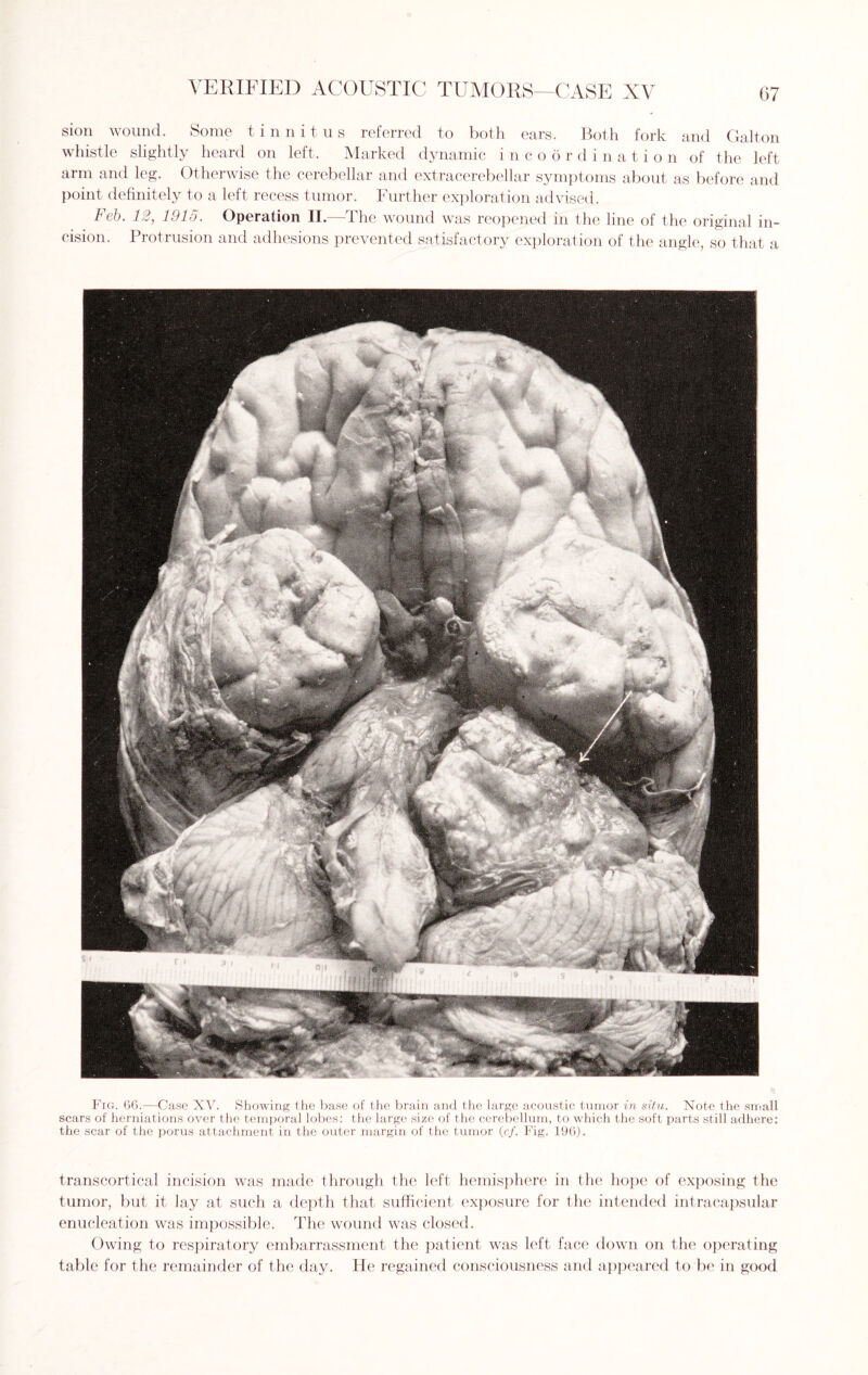 sion wound. Some tinnitus referred to both ears. Both fork and Galton whistle slightly heard on left. Marked dynamic incoordination of the left arm and leg. Otherwise the cerebellar and extracerebellar symptoms about as before and point definitely to a left recess tumor. Further exploration advised. Feb. 12, 1915. Operation II.—The wound was reopened in the line of the original in¬ cision. Protrusion and adhesions prevented satisfactory exploration of the angle, so that a Fig. 66.—Case XV. Showing the base of the brain and the large acoustic tumor in situ. Note the small scars of herniations over the temporal lobes: the large size of the cerebellum, to which the soft parts still adhere: the scar of the porus attachment in the outer margin of the tumor (c/. Fig. 196). transcortical incision was made through the left hemisphere in the hope of exposing the tumor, but it lay at such a depth that sufficient exposure for the intended intracapsular enucleation was impossible. The wound was closed. Owing to respiratory embarrassment the patient was left face down on the operating table for the remainder of the day. He regained consciousness and appeared to be in good