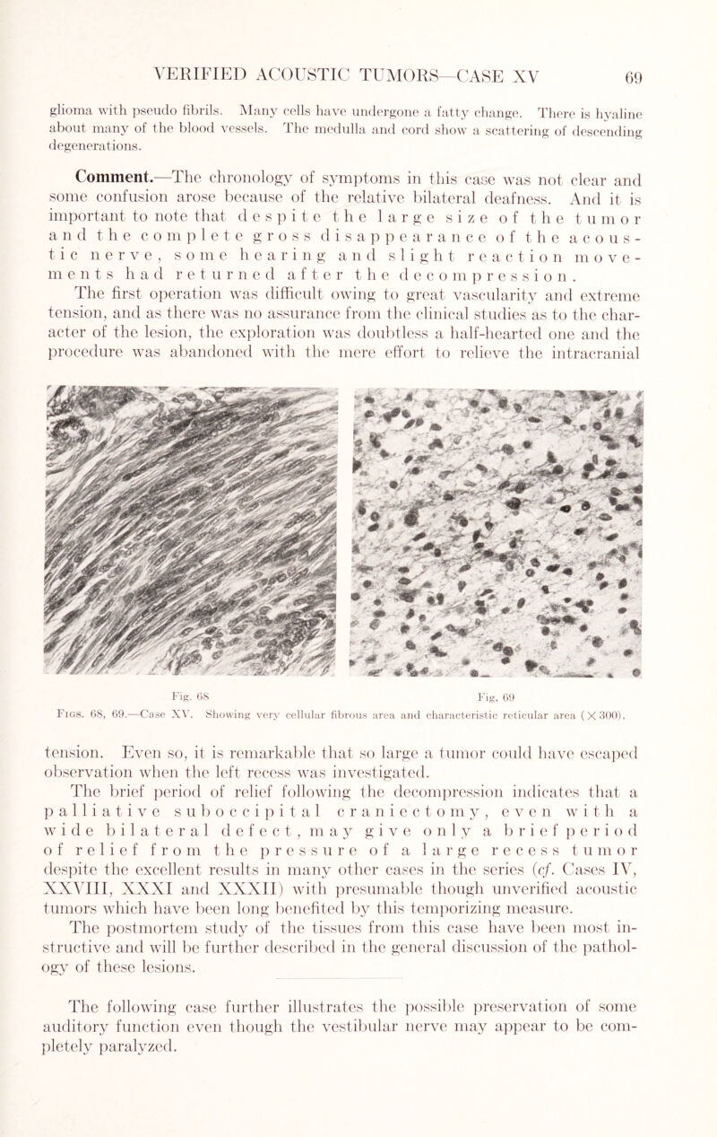 glioma with pseudo fibrils. Many cells have undergone a fatty change. There is hyaline about many of the blood vessels. The medulla and cord show a scattering of descending degenerations. Comment.—The chronology of symptoms in this case was not clear and some confusion arose because of the relative bilateral deafness. And it is important to note that despite the large size of the tumor and t he c o m p 1 e t e gross disappearance of the acous¬ tic nerve, some hearing and slight reaction move- m e n t s had re t u r n e d aft e r t h e decompression. The first operation was difficult owing to great vascularity and extreme tension, and as there was no assurance from the clinical studies as to the char¬ acter of the lesion, the exploration was doubtless a half-hearted one and the procedure was abandoned with the mere effort to relieve the intracranial Fig. 68 Fig. 69 Figs. 68, 69.—Case XV. Showing very cellular fibrous area and characteristic reticular area (X300). tension. Even so, it is remarkable that so large a tumor could have escaped observation when the left recess was investigated. The brief period of relief following the decompression indicates that a palliative suboccipital craniectomy, even with a wide bilateral defect, may give only a brief period of relief from the pressure of a large recess tumor despite the excellent results in many other cases in the series (cf. Cases IV, XXVIII, XXXI and XXXII) with presumable though unverified acoustic tumors which have been long benefited by this temporizing measure. The postmortem study of the tissues from this case have been most in¬ structive and will be further described in the general discussion of the pathol¬ ogy of these lesions. The following case further illustrates the possible preservation of some auditory function even though the vestibular nerve may appear to be com¬ pletely paralyzed.