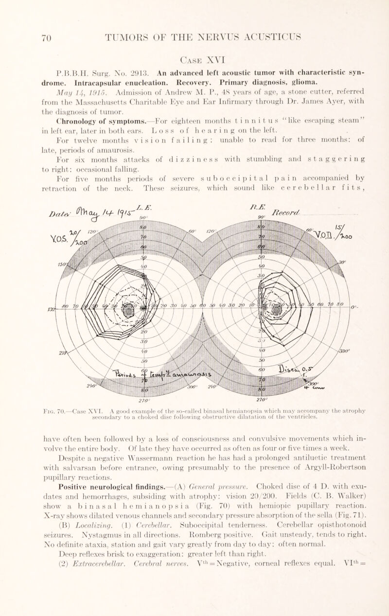 Case XVI P.B.B.H. Surg. No. 2913. An advanced left acoustic tumor with characteristic syn¬ drome. Intracapsular enucleation. Recovery. Primary diagnosis, glioma. May 14, 1915. Admission of Andrew M. P., 48 years of age, a stone cutter, referred from the Massachusetts Charitable Eye and Ear Infirmary through Dr. James Ayer, with the diagnosis of tumor. Chronology of symptoms.—For eighteen months tinnitus “like escaping steam’ in left ear, later in both ears. Loss of hearing on the left. For twelve months vision failing: unable to read for three months: of late, periods of amaurosis. For six months attacks of dizziness with stumbling and staggering to right: occasional falling. For five months periods of severe suboccipital pain accompanied by retraction of the neck. These seizures, which sound like cerebellar fits, Data /cy- R.K 90° Record 130 !S/ ~Y0.I1. Aoo K3000 Uvw 270° 270° Fig. 70.—Case XVI. A good example of the so-called binasal hemianopsia which may accompany the atrophy secondary to a choked disc following obstructive dilatation of the ventricles. have often been followed by a loss of consciousness and convulsive movements which in¬ volve the entire body. Of late they have occurred as often as four or five times a week. Despite a negative Wassermann reaction he has had a prolonged antiluetic treatment with salvarsan before entrance, owing presumably to the presence of Argyll-Robertson pupillary reactions. Positive neurological findings.—(A) General pressure. Choked disc of 4 D. with exu¬ dates and hemorrhages, subsiding with atrophy: vision 20/200. Fields (C. B. Walker) show a binasal hemianopsia (Fig. 70) with hemiopic pupillary reaction. X-ray shows dilated venous channels and secondary pressure absorption of the sella (Fig. 71). (B) Localizing. (1) Cerebellar. Suboccipital tenderness. Cerebellar opisthotonoid seizures. Nystagmus in all directions. Romberg positive. Gait unsteady, tends to right. No definite ataxia, station and gait vary greatly from day to day: often normal. Dee]) reflexes brisk to exaggeration: greater left than right. (2) Extracerebellar. Cerebral nerves. Vth = Negative, corneal reflexes equal. VIth =