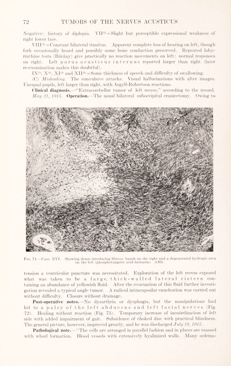 Negative: history of diplopia. VIIth = Slight but perceptible expressional weakness of right lower face. VIIIth = Constant bilateral tinnitus. Apparent complete loss of hearing on left, though fork occasionally heard and possibly some bone conduction preserved. Repeated laby¬ rinthine tests (Barany) give practically no reaction movements on left: normal responses on right. Left p o r u s a custieus inte r n u s reported larger than right (later re-examination makes this doubtful). IXth, Xth, XIth and XIIth = Some thickness of speech and difficulty of swallowing. (C) Misleading. The convulsive attacks. Visual hallucinations with after images. Unequal pupils, left larger than right, with Argyll-Robertson reactions. Clinical diagnosis.—“Extracerebellar tumor of left recess,” according to the record. May 21, 1915. Operation.—The usual bilateral suboccipital craniectomy. Owing to Fig. 74.—Case XVI. Showing dense interlacing fibrous bands on the right and a degenerated hydropic area on the left (phosphotungstic acid haematin: X80). tension a ventricular puncture was necessitated. Exploration of the left recess exposed what was taken to be a large, thick-walled lateral cistern con¬ taining an abundance of yellowish fluid. After the evacuation of this fluid further investi¬ gation revealed a typical angle tumor. A radical intracapsular enucleation was carried out without difficulty. Closure without drainage. Post-operative notes.—No dysarthria or dysphagia, but the manipulations had led to a palsy of the left abducens and left facial nerves (Fig. 72). Healing without reaction (Fig. 73). Temporary increase of incoordination of left side with added impairment of gait. Subsidence of choked disc with practical blindness. The general picture, however, improved greatly, and he was discharged July 18, 1915. Pathological note.—“The cells are arranged in parallel fashion and in places are massed with whorl formation. Blood vessels with extensively hyalinized walls. Many oedema-