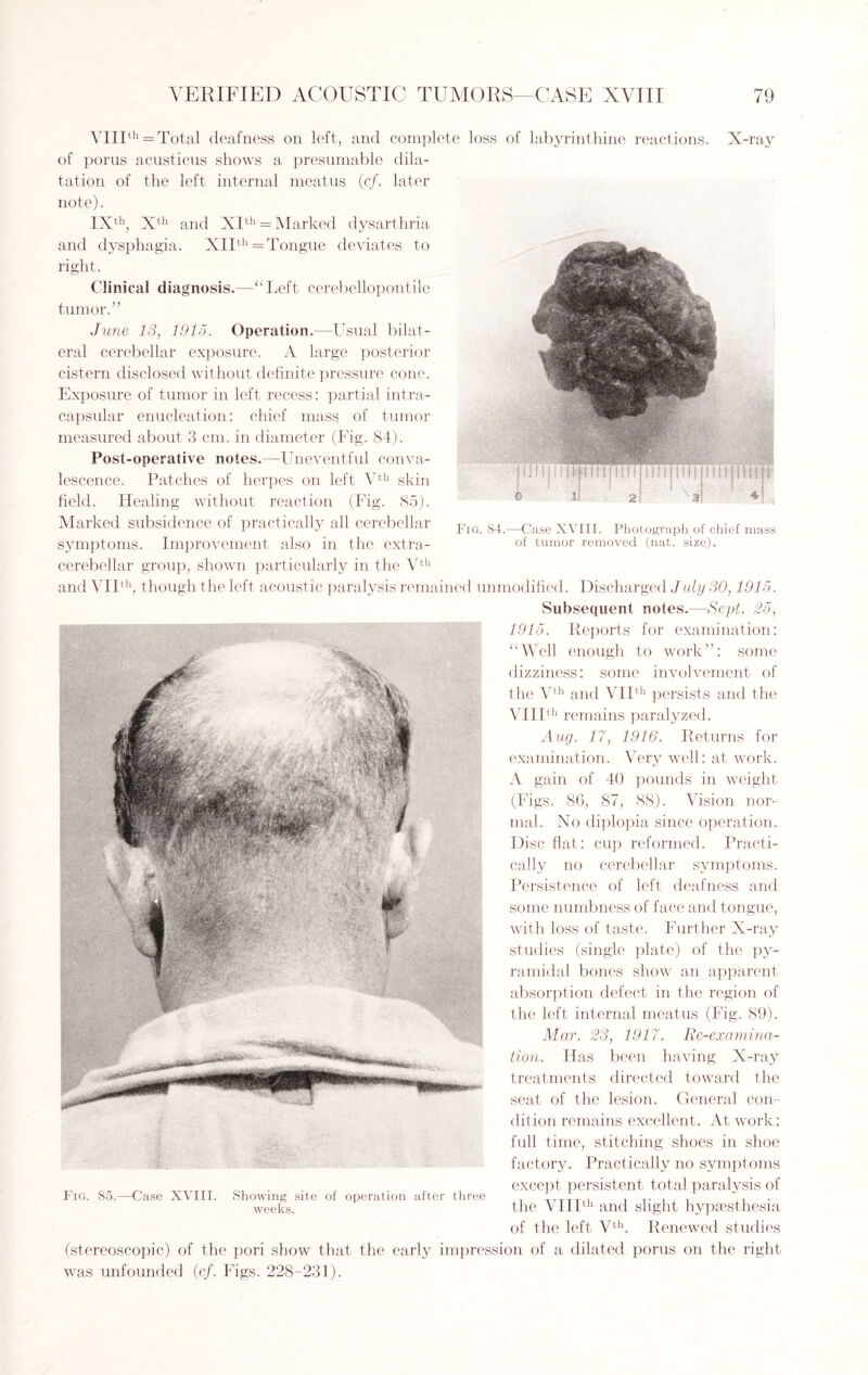 VIIIth = Total deafness on left, and complete loss of labyrinthine reactions. X-ra; of porus acusticus shows a presumable dila¬ tation of the left internal meatus (cf. later note). IXth, Xth and XIth = Marked dysarthria and dysphagia. XIIth = Tongue deviates to right. Clinical diagnosis.—“Left cerebellopontile tumor.” June 13, 1915. Operation.—Usual bilat¬ eral cerebellar exposure. A large posterior cistern disclosed without definite pressure cone. Exposure of tumor in left recess: partial intra- capsular enucleation: chief mass of tumor measured about 3 cm. in diameter (Fig. 84). Post-operative notes.—Uneventful conva¬ lescence. Patches of herpes on left Vth skin field. Healing without reaction (Fig. 85). Marked subsidence of practically all cerebellar symptoms. Improvement also in the extra- cerebellar group, shown particularly in the Vth and VIIth, though the left acoustic paralysis remained unmodified. Discharged July 30,1915. Subsequent notes.—Sept. 25, 1915. Reports for examination: “Well enough to work”: some dizziness: some involvement of the Vth and VIIth persists and the VIIIth remains paralyzed. Aug. 17, 1916. Returns for examination. Very well: at work. A gain of 40 pounds in weight (Figs. 86, 87, 88). Vision nor¬ mal. No diplopia since operation. Disc flat: cup reformed. Practi¬ cally no cerebellar symptoms. Persistence of left deafness and some numbness of face and tongue, with loss of taste. Further X-ray studies (single plate) of the py¬ ramidal bones show an apparent absorption defect in the region of the left internal meatus (Fig. 89). Mar. 23, 1917. Re-examina¬ tion. Has been having X-ray treatments directed toward the seat of the lesion. General con¬ dition remains excellent. At work: full time, stitching shoes in shoe factory. Practically no symptoms except persistent total paralysis of the VIIIth and slight hypsesthesia of the left Vth. Renewed studies (stereoscopic) of the pori show that the early impression of a dilated porus on the right was unfounded (cf. Figs. 228-231). Fig. 85.—Case XVIII. Showing site of operation after three weeks. Fig. 84.—Case XVIII. Photograph of chief mass of tumor removed (nat. size).