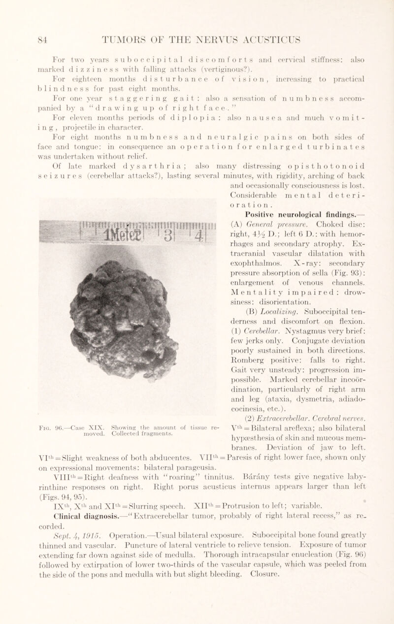 For two years suboccipital discomfo r t s and cervical stiffness: also marked dizziness with falling attacks (vertiginous?). For eighteen months disturbance of vision, increasing to practical blindness for past eight months. For one year s t a g g e r i n g gait: also a sensation of n u m b n e s s accom¬ panied by a “drawing up of right face.” For eleven months periods of diplopia: also nausea and much vomit¬ ing, projectile in character. For eight months n u m b n e s s and neuralgic pains on both sides of face and tongue: in consequence an o p e r a t i o n for e n larged turbinates was undertaken without relief. Of late marked dysarthria ; also many distressing opisthotonoid seizures (cerebellar attacks?), lasting several minutes, with rigidity, arching of back and occasionally consciousness is lost. Considerable mental deteri¬ oration. Positive neurological findings.— (A) General pressure. Choked disc: right, 4^2 F>.; left 6 D.: with hemor¬ rhages and secondary atrophy. Ex¬ tracranial vascular dilatation with exophthalmos. X-ray: secondary pressure absorption of sella (Fig. 93): enlargement of venous channels. Mentality impaired: drow¬ siness : disorientation. (B) Localizing. Suboccipital ten¬ derness and discomfort on flexion. (1) Cerebellar. Nystagmus very brief: few jerks only. Conjugate deviation poorly sustained in both directions. Romberg positive: falls to right. Gait very unsteady: progression im¬ possible. Marked cerebellar incoor¬ dination, particularly of right arm and leg (ataxia, dysmetria, adiado- cocinesia, etc.). (2) Extracerebellar. Cerebral nerves. Vth = Bilateral areflexa; also bilateral hypaesthesia of skin and mucous mem¬ branes. Deviation of jaw to left. VIth = Slight weakness of both abducentes. VIIth = Paresis of right lower face, shown only on expressional movements: bilateral parageusia. VIIIth = Right deafness with “roaring” tinnitus. Barany tests give negative laby¬ rinthine responses on right. Right porus acusticus interims appears larger than left (Figs. 94, 95). IXth, Xth and XIth = Slurring speech. XIIth = Protrusion to left; variable. Clinical diagnosis.—-“Extracerebellar tumor, probably of right lateral recess,” as re¬ corded. Sept. 4, 1915. Operation.—Usual bilateral exposure. Suboccipital bone found greatly thinned and vascular. Puncture of lateral ventricle to relieve tension. Exposure of tumor extending far down against side of medulla. Thorough intracapsular enucleation (Fig. 96) followed by extirpation of lower two-thirds of the vascular capsule, which was peeled from the side of the pons and medulla with but slight bleeding. Closure. Fig. 96.—Case XIX. Showing the amount of tissue re¬ moved. Collected fragments.