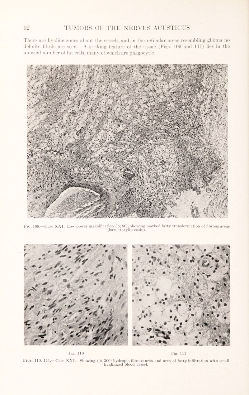 There are hyaline zones about the vessels, and in the reticular areas resembling glioma no definite fibrils are seen. A striking feature of the tissue (Figs. 109 and 111) lies in the unusual number of fat cells, many of which are phagocytic. 1 , • v * r, • * f ^ ■ 1 * ;.y; f -m vSwp -.M&i i v&sQS ;‘v#rv:^ *Cik i '*>v *LSgy f y A •« .• -Av* ; « > if.- « * < Fig. 109.—Case XXI. Low power magnification (X 80), showing marked fatty transformation of fibrous areas (hsematoxylin eosin). Fig. 110 Fig. Ill Figs. 110, 111.—Case XXI. Showing (X 300) hydropic fibrous area and area of fatty infiltration with small hyalinized blood vessel.