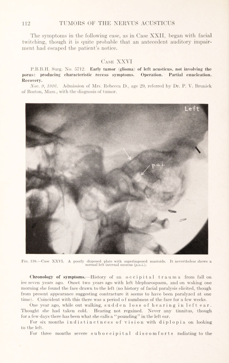 twitching, though it is quite probable that an antecedent auditory impair¬ ment had escaped the patient’s notice. Case XXVI P.B.B.H. Surg. No. 5712. Early tumor (glioma) of left acusticus, not involving the porus: producing characteristic recess symptoms. Operation. Partial enucleation. Recovery. Nov. 9, 1916. Admission of Mrs. Rebecca D., age 29, referred by Dr. P. V. Brunick of Boston, Mass., with the diagnosis of tumor. Fig. 138.—Case XXVI. A poorly disposed plate with superimposed mastoids. It nevertheless shows a normal left internal meatus (p.a.i.). Chronology of symptoms.—History of an occipital trauma from fall on ice seven years ago. Onset two years ago with left blepharospasm, and on waking one morning she found the face drawn to the left (no history of facial paralysis elicited, though from present appearance suggesting contracture it seems to have been paralyzed at one time). Coincident with this there was a period o f numbness of the face for a few weeks. One year ago, while out walking, sudden loss of hearing in left ear. Thought she had taken cold. Hearing not regained. Never any tinnitus, though for a few days there has been what she calls a “pmmding” in the left ear. For six months indistinctness of vision with diplopia on looking to the left. For three months severe sub occipital discomforts radiating to the