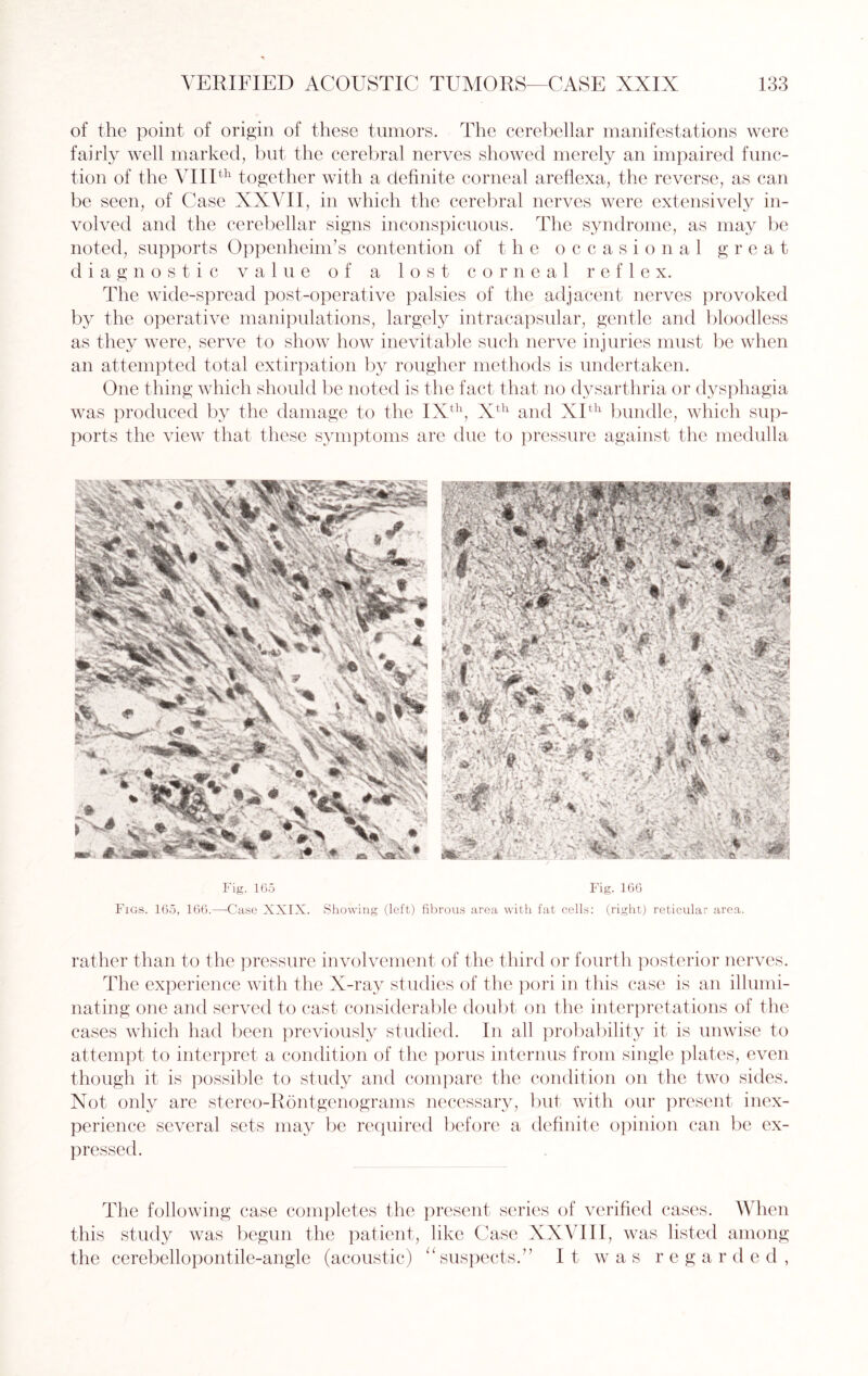 of the point of origin of these tumors. The cerebellar manifestations were fairly well marked, but the cerebral nerves showed merely an impaired func¬ tion of the VIIIth together with a definite corneal areflexa, the reverse, as can be seen, of Case XXVII, in which the cerebral nerves were extensively in¬ volved and the cerebellar signs inconspicuous. The syndrome, as may be noted, supports Oppenheim’s contention of the occasional great diagnostic value of a lost corneal reflex. The wide-spread post-operative palsies of the adjacent nerves provoked by the operative manipulations, largely intracapsular, gentle and bloodless as they were, serve to show how inevitable such nerve injuries must be when an attempted total extirpation by rougher methods is undertaken. One thing which should be noted is the fact that no dysarthria or dysphagia was produced by the damage to the IXth, Xth and XIth bundle, which sup¬ ports the view that these symptoms are due to pressure against the medulla Fig. 165 Fig. 166 Figs. 165, 166.—Case XXIX. Showing (left) fibrous area with fat cells: (right) reticular area. rather than to the pressure involvement of the third or fourth posterior nerves. The experience with the X-ray studies of the pori in this case is an illumi¬ nating one and served to cast considerable doubt on the interpretations of the cases which had been previously studied. In all probability it is unwise to attempt to interpret a condition of the porus interims from single plates, even though it is possible to study and compare the condition on the two sides. Not only are stereo-Rontgenograms necessary, but with our present inex¬ perience several sets may be required before a definite opinion can be ex¬ pressed. The following case completes the present series of verified cases. When this study was begun the patient, like Case XXVIII, was listed among the cerebellopontile-angle (acoustic) “suspects.” It was regarded,