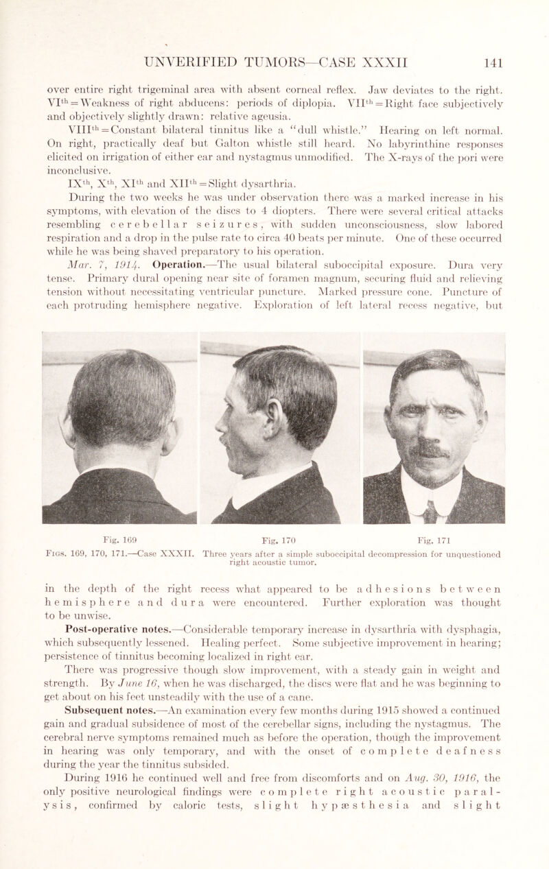 over entire right trigeminal area with absent corneal reflex. Jaw deviates to the right. VIth = Weakness of right abducens: periods of diplopia. VIIth = Right face subjectively and objectively slightly drawn: relative ageusia. VIIIth = Constant bilateral tinnitus like a “dull whistle.” Hearing on left normal. On right, practically deaf but Galton whistle still heard. No labyrinthine responses elicited on irrigation of either ear and nystagmus unmodified. The X-rays of the pori were inconclusive. IXth, Xth, XIth and XIIth = Slight dysarthria. During the two weeks he was under observation there was a marked increase in his symptoms, with elevation of the discs to 4 diopters. There were several critical attacks resembling cerebellar seizures, with sudden unconsciousness, slow labored respiration and a drop in the pulse rate to circa 40 beats per minute. One of these occurred wdiile he was being shaved preparatory to his operation. Mar. 7, 1914. Operation.—-The usual bilateral suboccipital exposure. Dura very tense. Primary dural opening near site of foramen magnum, securing fluid and relieving tension without necessitating ventricular puncture. Marked pressure cone. Puncture of each protruding hemisphere negative. Exploration of left lateral recess negative, but Fig. 169 Fig. 170 Fig. 171 Figs. 169, 170, 171.—Case XXXII. Three years after a simple suboccipital decompression for unquestioned right acoustic tumor. in the depth of the right recess what appeared to be adhesions between hemisphere and dura were encountered. Further exploration was thought to be unwise. Post-operative notes.—Considerable temporary increase in dysarthria with dysphagia, which subsequently lessened. Healing perfect. Some subjective improvement in hearing; persistence of tinnitus becoming localized in right ear. There was progressive though slow improvement, with a steady gain in weight and strength. By June 16, when he was discharged, the discs were flat and he was beginning to get about on his feet unsteadily with the use of a cane. Subsequent notes.—An examination every few months during 1915 showed a continued gain and gradual subsidence of most of the cerebellar signs, including the nystagmus. The cerebral nerve symptoms remained much as before the operation, though the improvement in hearing was only temporary, and with the onset of complete deafness during the year the tinnitus subsided. During 1916 he continued well and free from discomforts and on Aug. 30, 1916, the only positive neurological findings were complete right acoustic paral¬ ysis, confirmed by caloric tests, slight hypsesthesia and slight