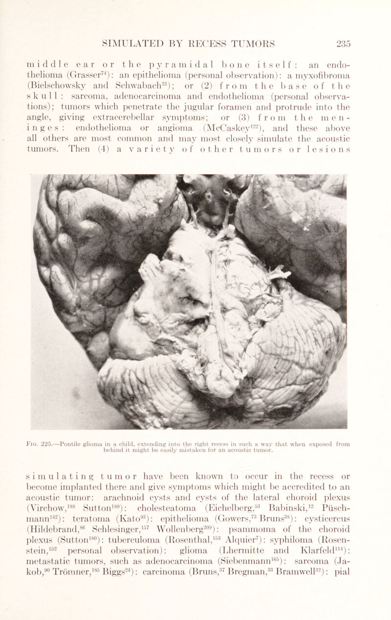 m i cl die ear or t, h e p y r a m i d a 1 bone itself: an endo¬ thelioma (Crasser74): an epithelioma (personal observation): a myxofibroma (Bielschowsky and Schwabach23); or (2) from the base of the skull : sarcoma, adenocarcinoma and endothelioma (personal observa¬ tions); tumors which penetrate the jugular foramen and protrude into the angle, giving extracerebellar symptoms; or (3) from the men¬ inges : endothelioma or angioma (McCaskey122), and these above all others are most common and may most closely simulate the acoustic tumors. Then (4) a variety of other tumors or lesions Fig. 225.—Pontile glioma in a child, extending into the right recess in such a way that when exposed from behind it might be easily mistaken for an acoustic tumor. s i m u 1 a t i n g t u m o r have been known to occur in the recess or become implanted there and give symptoms which might be accredited to an acoustic tumor: arachnoid cysts and cysts of the lateral choroid plexus (Virchow,188 Sutton180): cholesteatoma (Eiehelberg,53 Babinski,12 Piisch- mann142): teratoma (Kato93): epithelioma (Gowers,73 Bruns38): cysticercus (Hildebrand,86 Schlesinger,157 Wollenberg209): psammoma of the choroid plexus (Sutton180): tuberculoma (Rosenthal,153 Alquier7): syphiloma (Rosen- stein,152 personal observation): glioma (Lhermitte and Klarfeld114): metastatic tumors, such as adenocarcinoma (Siebenmann165): sarcoma (Ja¬ kob,90 Tromner,185 Biggs24): carcinoma (Bruns,37 Bregman,33 Bramwell32): pial