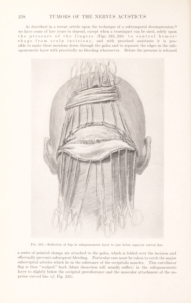 As described in a recent article upon the technique of a subtemporal decompression,48 we have come of late years to depend, except when a tourniquet can be used, solely upon the press u r e o f t h e f infers (Figs. 243, 244) to control hem o r - r h a g e from seal]) incisions, and with practised assistants it is pos¬ sible to make these incisions down through the galea and to separate the edges in the sub¬ aponeurotic layer with practically no bleeding whatsoever. Before the pressure is released Fig. 245.—Reflection of flap in subaponeurotic layer to just below superior curved line. a series of pointed clamps are attached to the galea, which is folded over the incision and effectually prevents subsequent bleeding. Particular care must be taken to catch the major suboccipital arteries which lie in the substance of the occipitalis muscles. This curvilinear flap is then “scalped” back (blunt dissection will usually suffice) in the subaponeurotic layer to slightly below the occipital protuberance and the muscular attachment of the su¬ perior curved line (cf. Fig. 245).