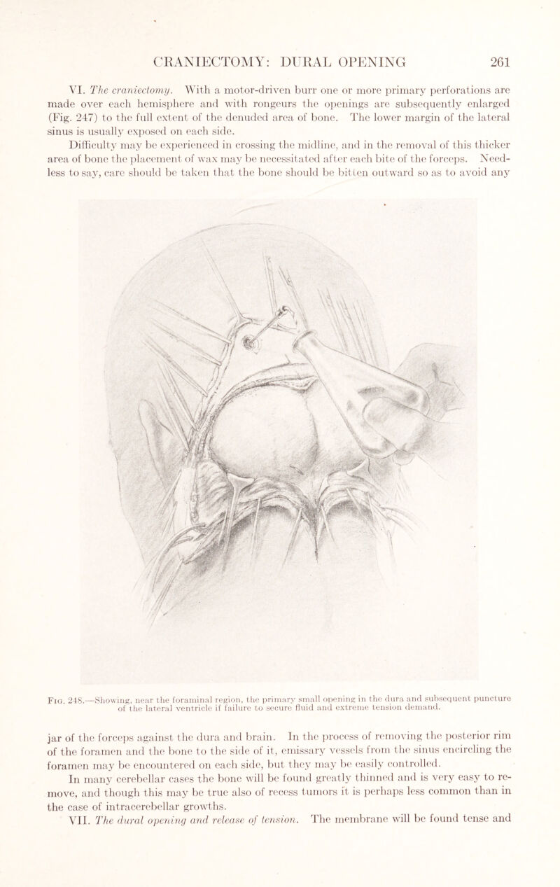 VI. The craniectomy. With a motor-driven burr one or more primary perforations are made over each hemisphere and with rongeurs the openings are subsequently enlarged (Fig. 247) to the full extent of the denuded area of bone. The lower margin of the lateral sinus is usually exposed on each side. Difficulty may be experienced in crossing the midline, and in the removal of this thicker area of bone the placement of wax may be necessitated after each bite of the forceps. Need¬ less to say, care should be taken that the bone should be bitten outward so as to avoid any Fig. 248.—Showing, near the foraminal region, the primary small opening in the dura and subsequent puncture of the lateral ventricle if failure to secure fluid and extreme tension demand. jar of the forceps against the dura and brain. In the process of removing the posterior rim of the foramen and the bone to the side of it, emissary vessels from the sinus encircling the foramen may be encountered on each side, but they may be easily controlled. In many cerebellar cases the bone will be found greatly thinned and is very easy to re¬ move, and though this may be true also of recess tumors it is perhaps less common than in the case of intracerebellar growths. VII. The dural opening and release of tension. The membrane will be found tense and