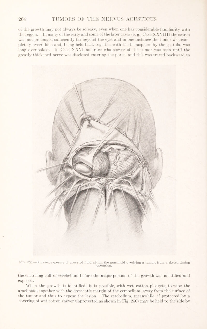 of the growth may not always be so easy, even when one lias considerable familiarity with the region. In many of the early and some of t he later eases (e. g., Case XXVIII) the search was not prolonged sufficiently far beyond the cyst and in one instance the tumor was com¬ pletely overridden and, being held back together with the hemisphere by the spatula, was long overlooked. In Case XXVI no trace whatsoever of the tumor was seen until the greatly thickened nerve was disclosed entering the porus, and this was traced backward to Fig. 250.—Showing exposure of encysted fluid within the arachnoid overlying a tumor, from a sketch during operation. the encircling cuff of cerebellum before the major portion of the growth was identified and exposed. When the growth is identified, it is possible, with wet cotton pledgets, to wipe the arachnoid, together with the crescentic margin of the cerebellum, away from the surface of the tumor and thus to expose the lesion. The cerebellum, meanwhile, if protected by a covering of wet cotton (never unprotected as shown in Fig. 250) may be held to the side by