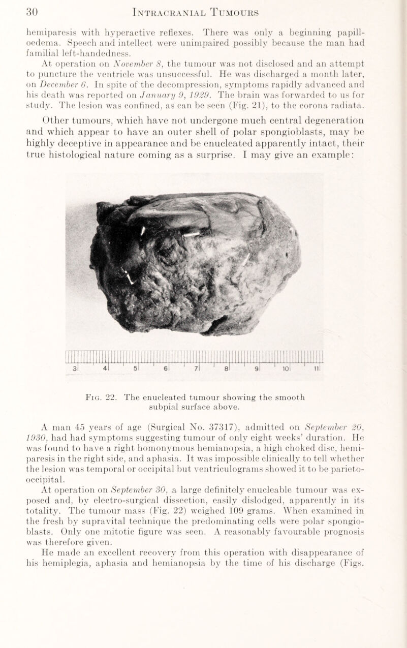 hemiparesis with hyperactive reflexes. There was only a beginning papill- oedema. Speech and intellect were unimpaired possibly because the man had familial left-handedness. At operation on November 8, the tumour was not disclosed and an attempt to puncture the ventricle was unsuccessful. He was discharged a month later, on December 6. In spite of the decompression, symptoms rapidly advanced and his death was reported on January 9, 1929. The brain was forwarded to us for study. The lesion was confined, as can be seen (Fig. 21), to the corona radiata. Other tumours, which have not undergone much central degeneration and which appear to have an outer shell of polar spongioblasts, may be highly deceptive in appearance and be enucleated apparently intact, their true histological nature coming as a surprise. I may give an example: Fig. 22. The enucleated tumour showing the smooth subpial surface above. A man 45 years of age (Surgical No. 37317), admitted on September 20, 1980, had had symptoms suggesting tumour of only eight weeks’ duration. He was found to have a right homonymous hemianopsia, a high choked disc, hemi¬ paresis in the right side, and aphasia. It was impossible clinically to tell whether the lesion was temporal or occipital but ventriculograms showed it to be parieto¬ occipital. At operation on September 30, a large definitely enucleable tumour was ex¬ posed and, by electro-surgical dissection, easily dislodged, apparently in its totality. The tumour mass (Fig. 22) weighed 109 grams. When examined in the fresh by supravital technique the predominating cells were polar spongio¬ blasts. Only one mitotic figure was seen. A reasonably favourable prognosis was therefore given. He made an excellent recovery from this operation with disappearance of his hemiplegia, aphasia and hemianopsia by the time of his discharge (Figs.