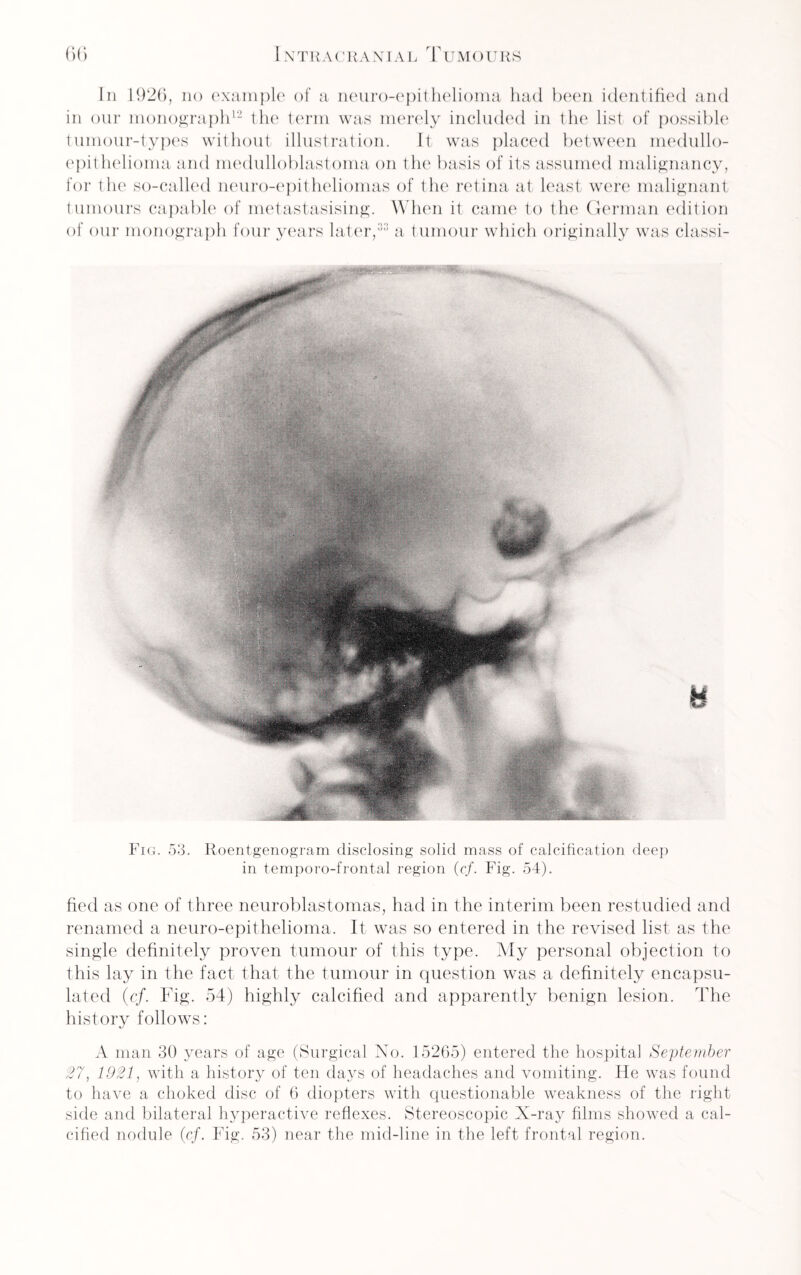 In 1926, no example of a neuro-epithelioma had been identified and in our monograph12 the term was merely included in the list of possible tumour-types without illustration. It was placed between medullo- epithelioma and medulloblastoma on the basis of its assumed malignancy, for the so-called neuro-epitheliomas of the retina at least were malignant tumours capable of metastasising. When it came to the German edition of our monograph four years later,33 a tumour which originally was classi- Fig. 53. Roentgenogram disclosing solid mass of calcification deep in temporo-frontal region (cf. Fig. 54). fied as one of three neuroblastomas, had in the interim been restudied and renamed a neuro-epithelioma. It was so entered in the revised list as the single definitely proven tumour of this type. My personal objection to this lay in the fact that the tumour in question was a definitely encapsu¬ lated (cf. Fig. 54) highly calcified and apparently benign lesion. The history follows: A man 30 years of age (Surgical No. 15265) entered the hospital September 27, 1921, with a history of ten days of headaches and vomiting. He was found to have a choked disc of 6 diopters with questionable weakness of the right side and bilateral hyperactive reflexes. Stereoscopic X-ray films showed a cal¬ cified nodule (cf. Fig. 53) near the mid-line in the left frontal region.